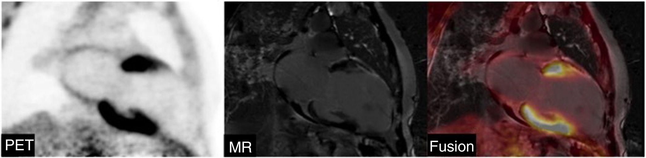 Additional value of hybrid PET/MR imaging versus MR or PET performed ...
