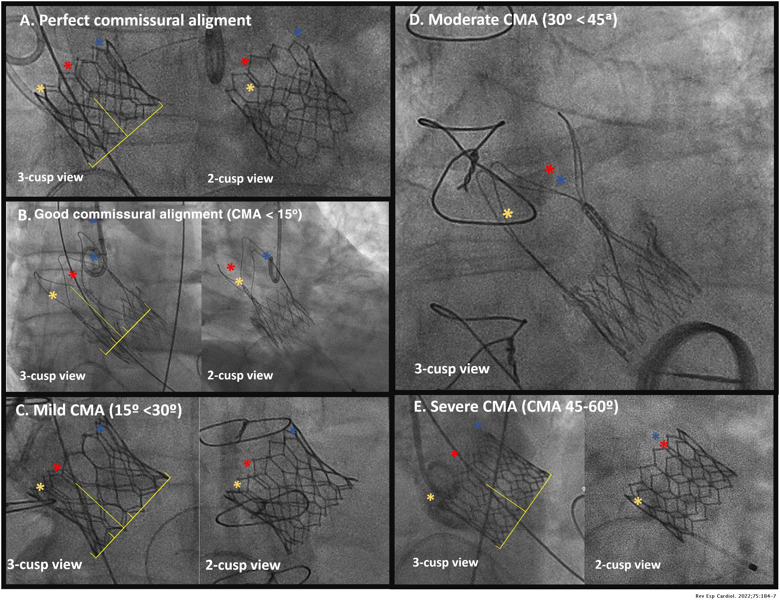 Fluoroscopic-based algorithm for commissural alignment assessment after ...