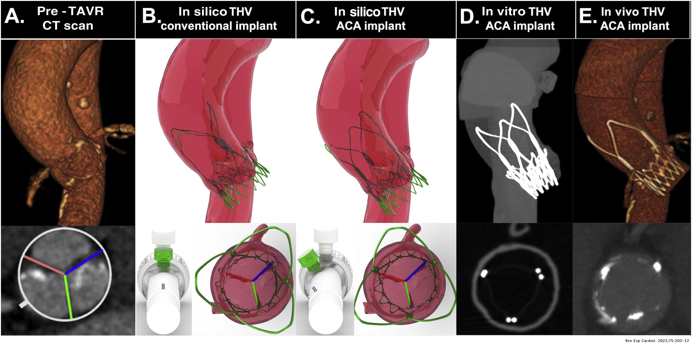 Accurate commissural alignment during ACURATE neo TAVI procedure. Proof ...