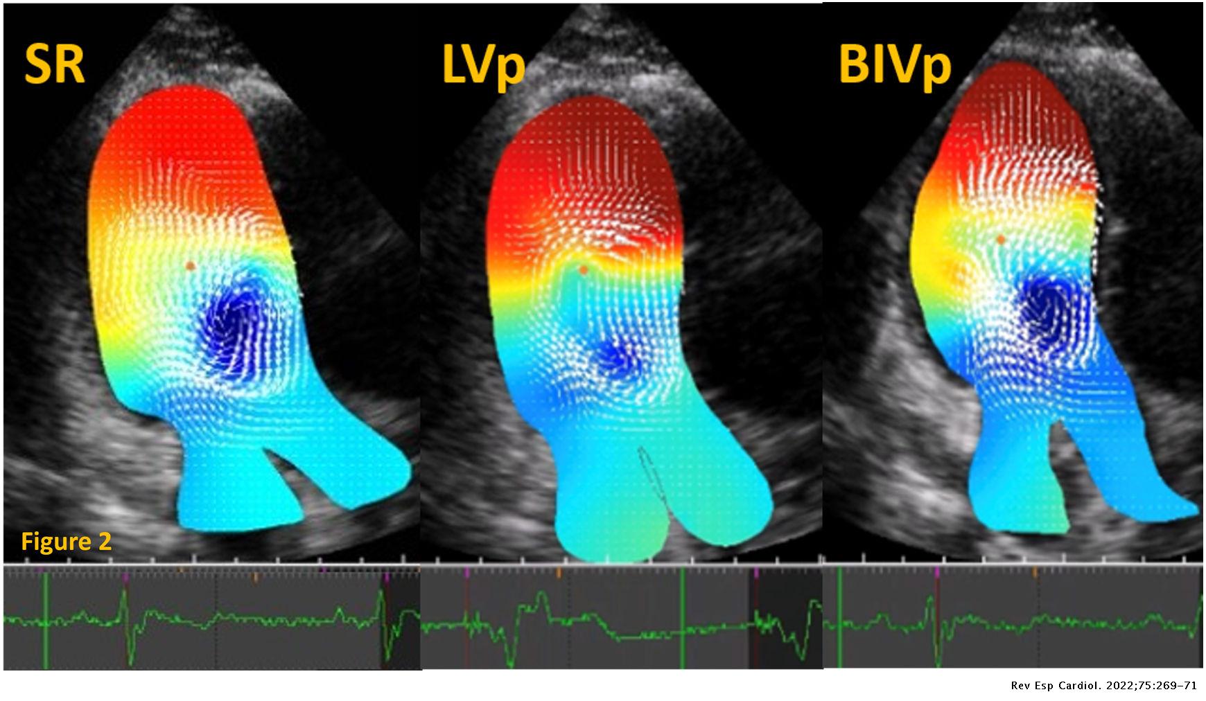 Vector flow mapping analysis in a child with a cardiac ...