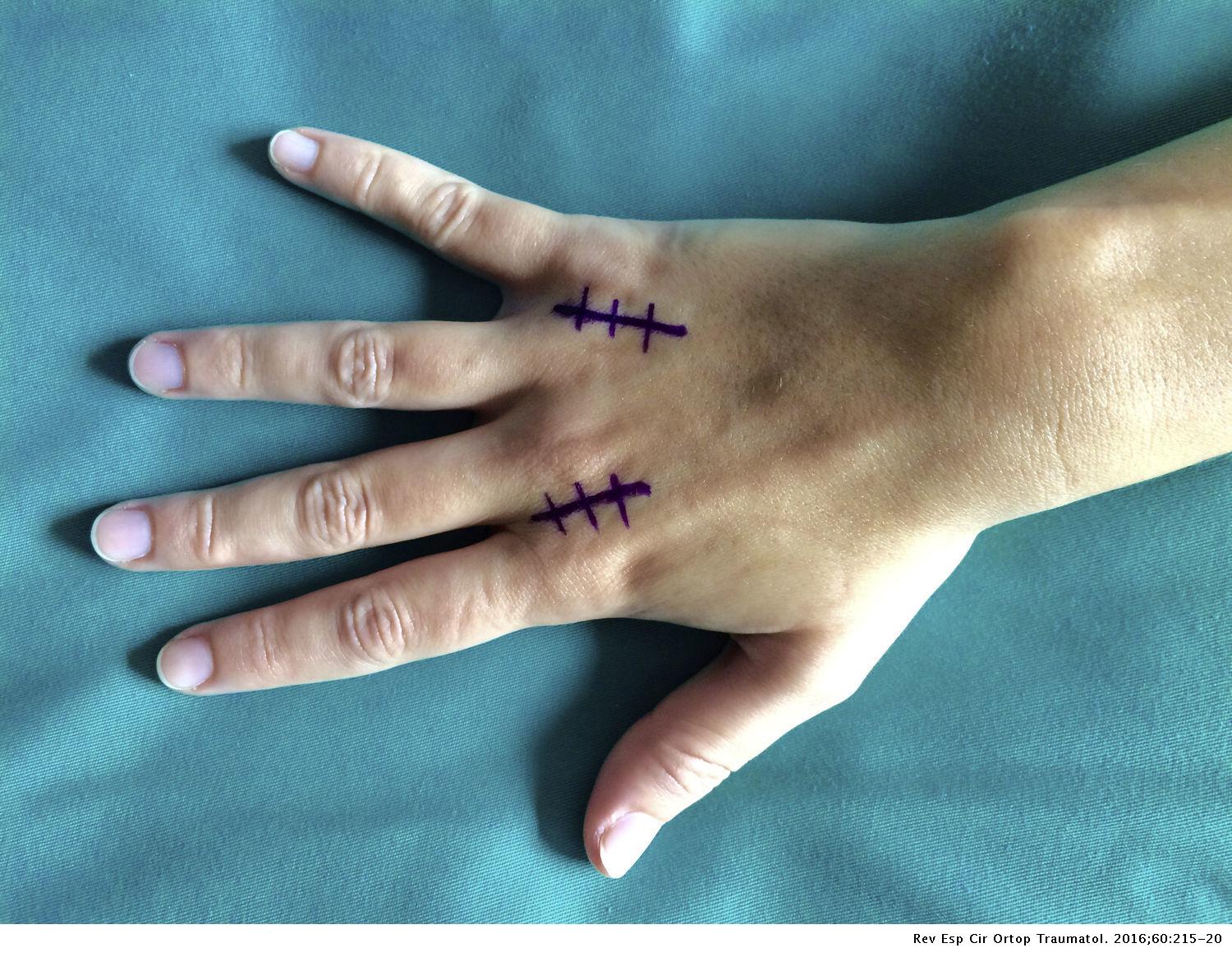 Rigideces metacarpofalángicas en extensión. ¿Un desafío para el ...