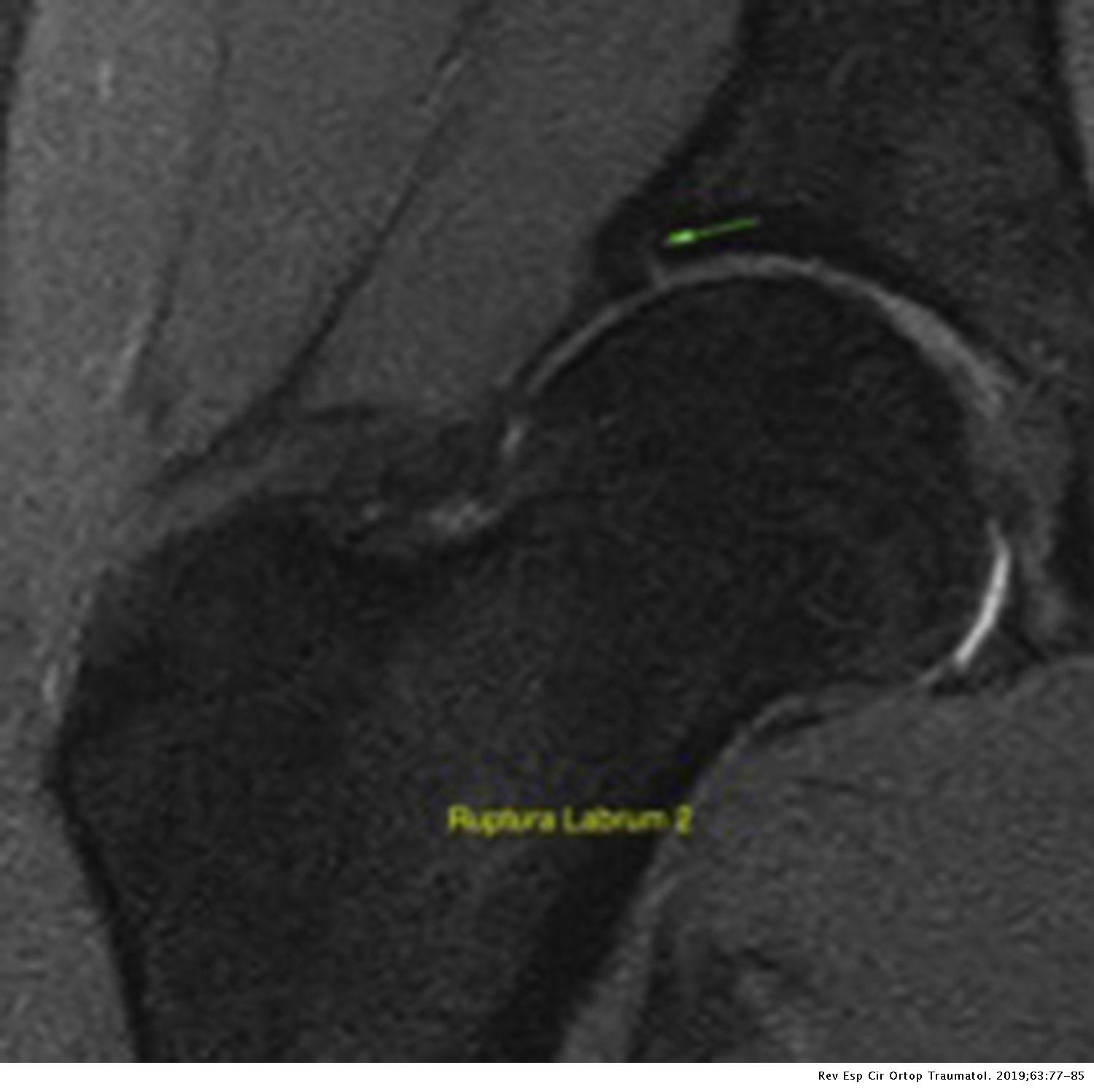 Prevalencia de lesiones del labrum y del cartílago articular de la ...