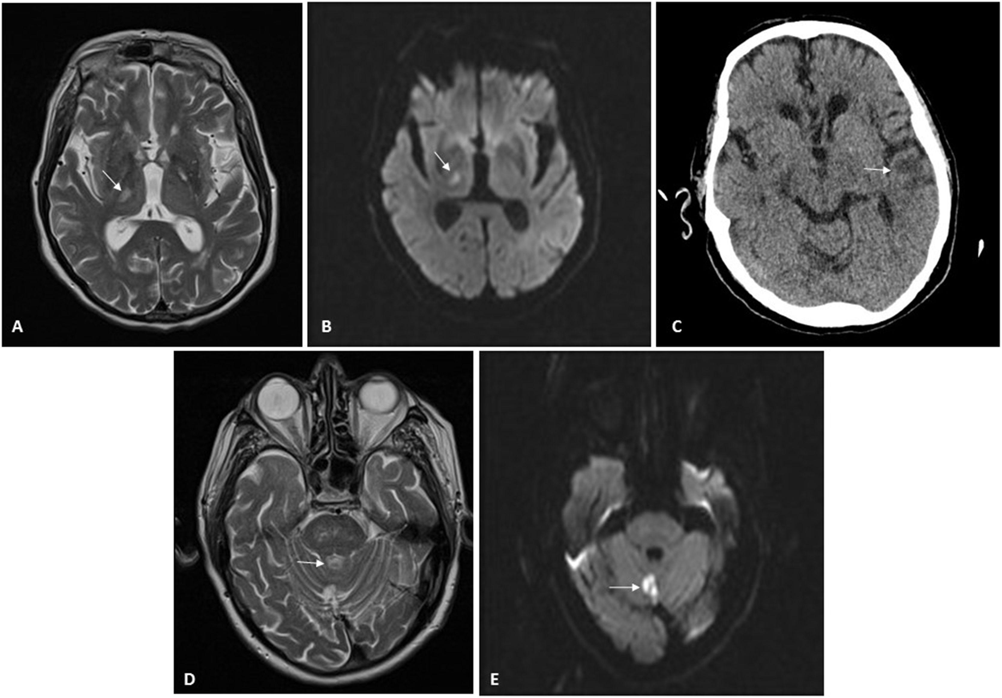 Ischaemic stroke associated with COVID-19 in dialysis patients | Nefrología