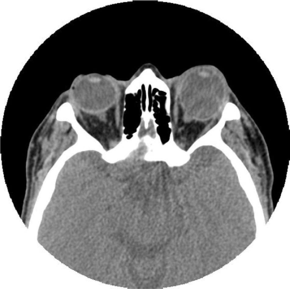 Unilateral exophthalmos and hypothyroidism | Endocrinología y Nutrición ...