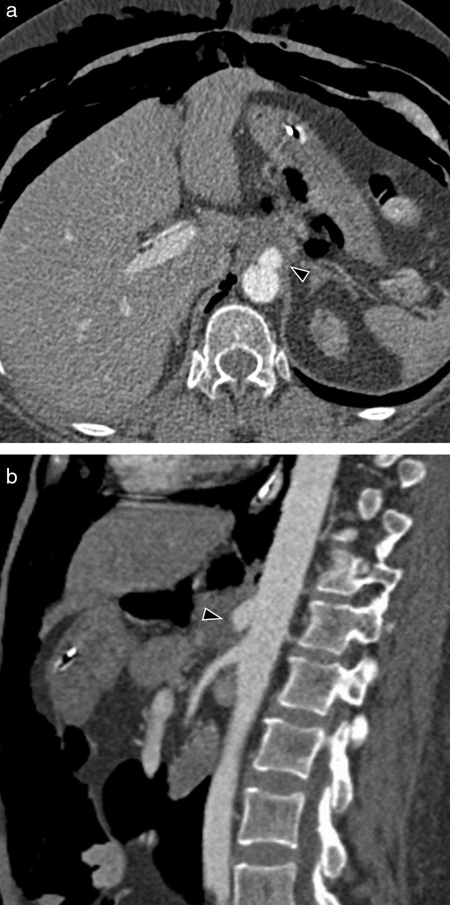 Nonurgent aortic disease: Clinical-radiological diagnosis of aortitis ...