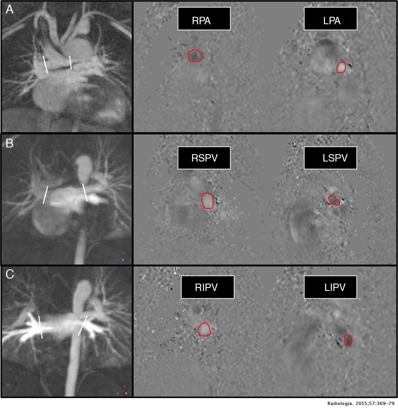 What radiologists need to know about the pulmonary–systemic flow ratio ...