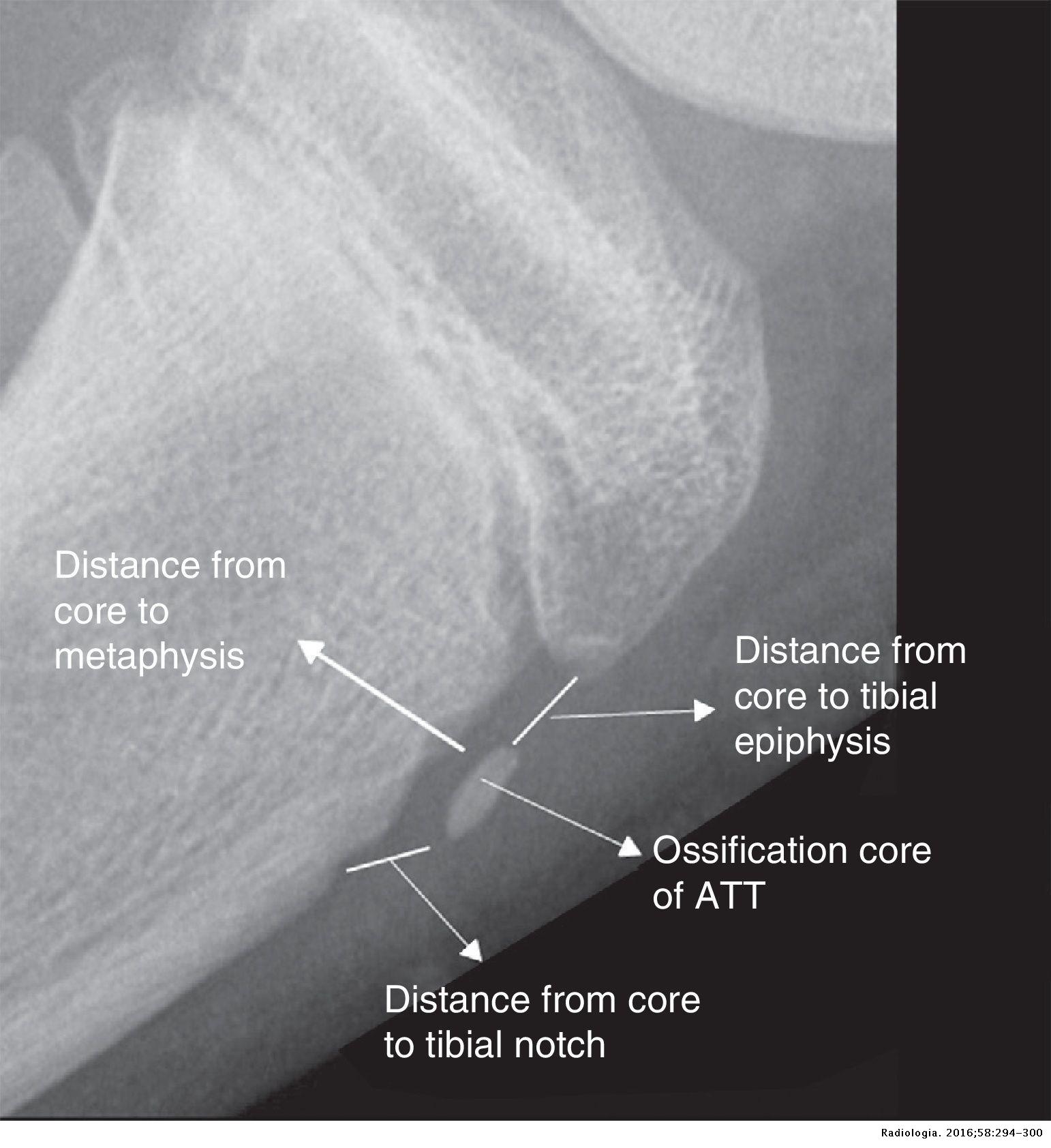 Radiographic features of the development of the anterior tibial ...