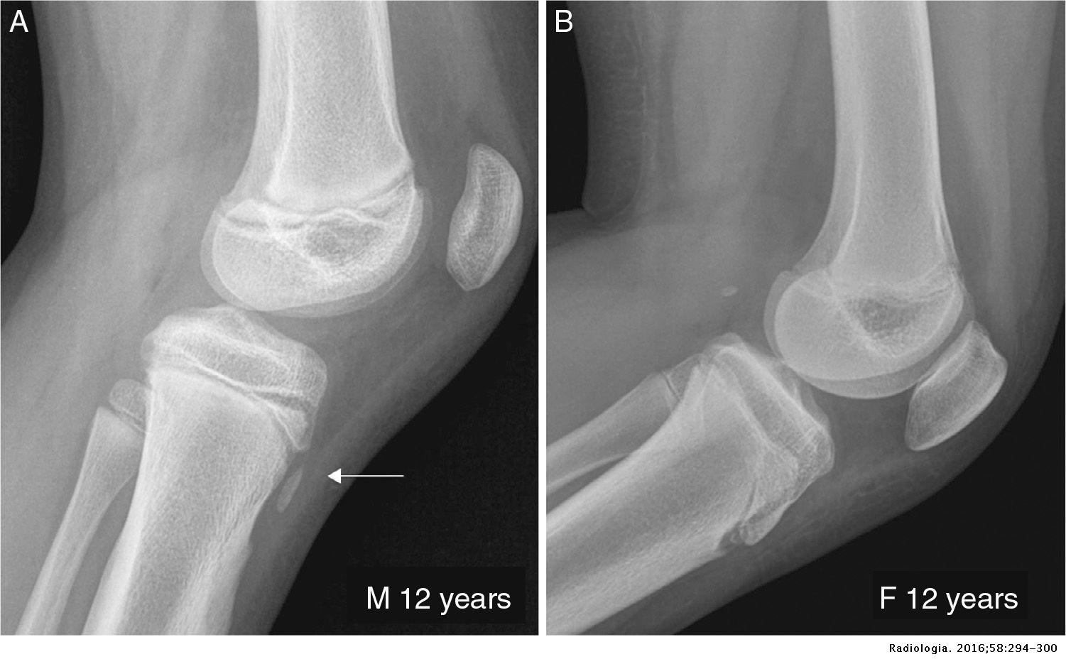 Radiographic features of the development of the anterior tibial ...