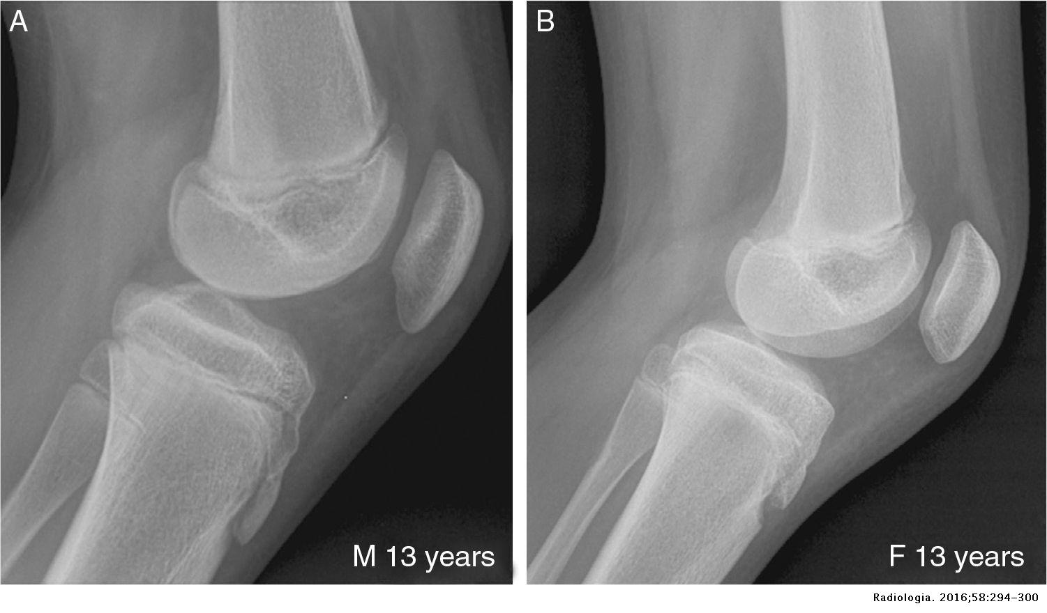 Radiographic features of the development of the anterior tibial ...