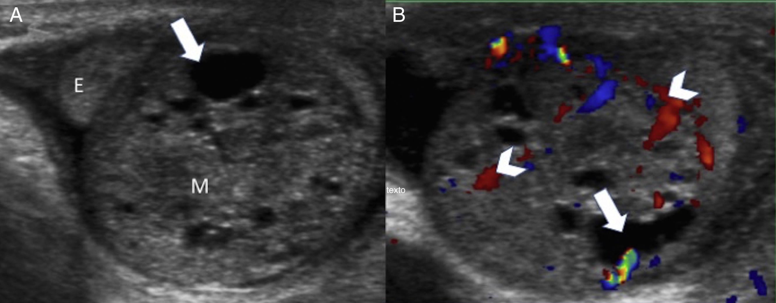 Perinatal testicular torsion Ultrasound assessment and differential