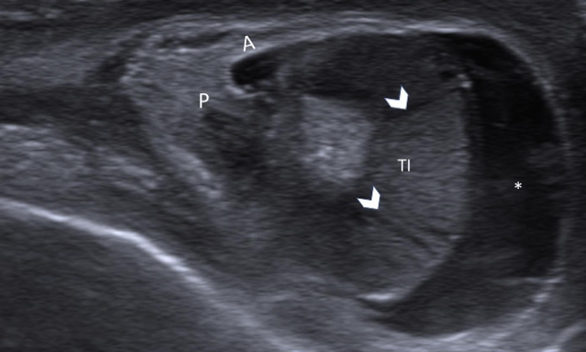 Perinatal testicular torsion Ultrasound assessment and differential