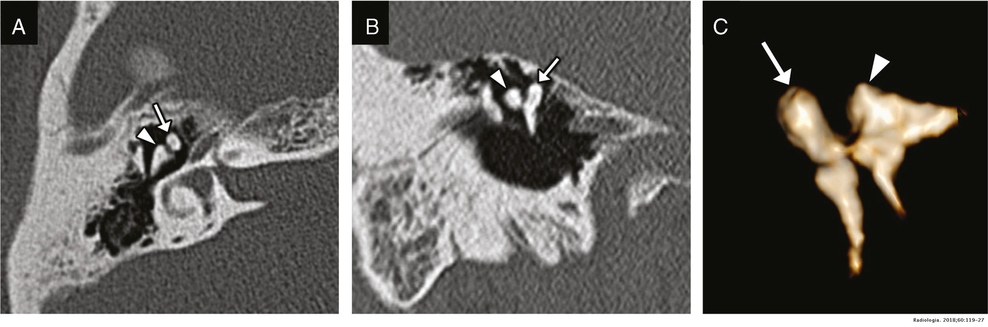 Imaging of post-traumatic hearing loss | Radiología (English Edition)