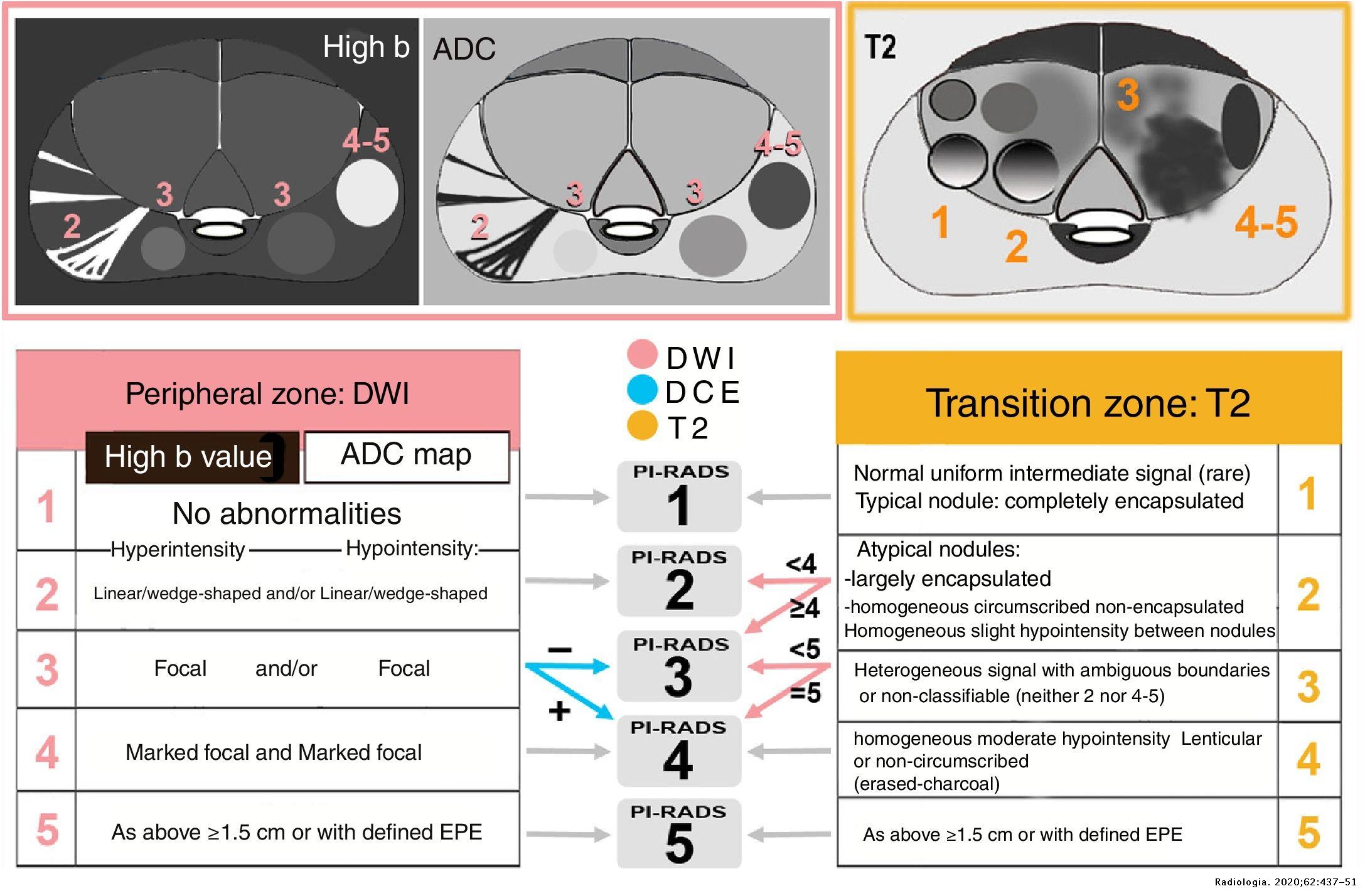 Prostate MRI: Practical guidelines for interpreting and reporting ...