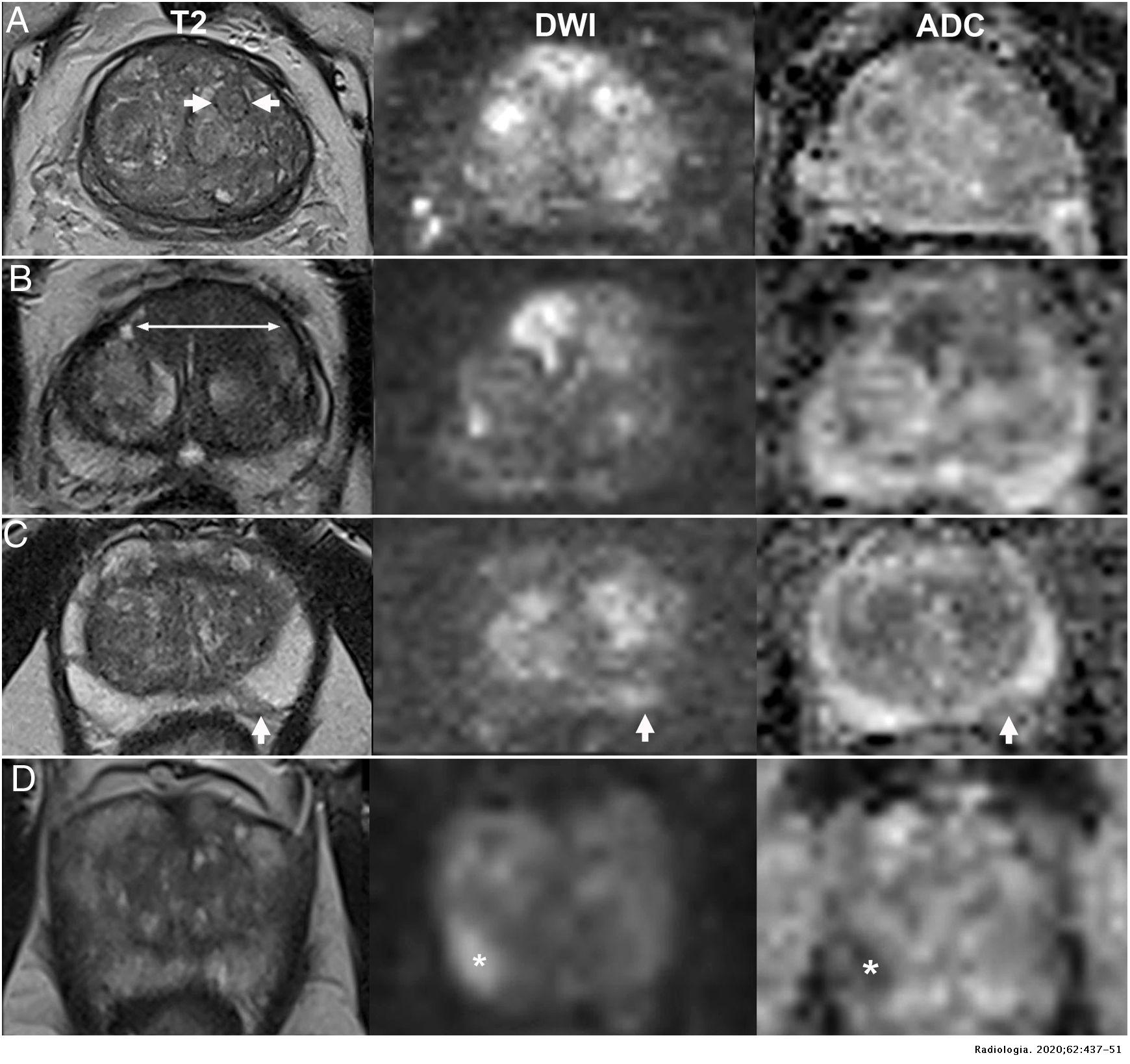 Prostate MRI: Practical guidelines for interpreting and reporting ...