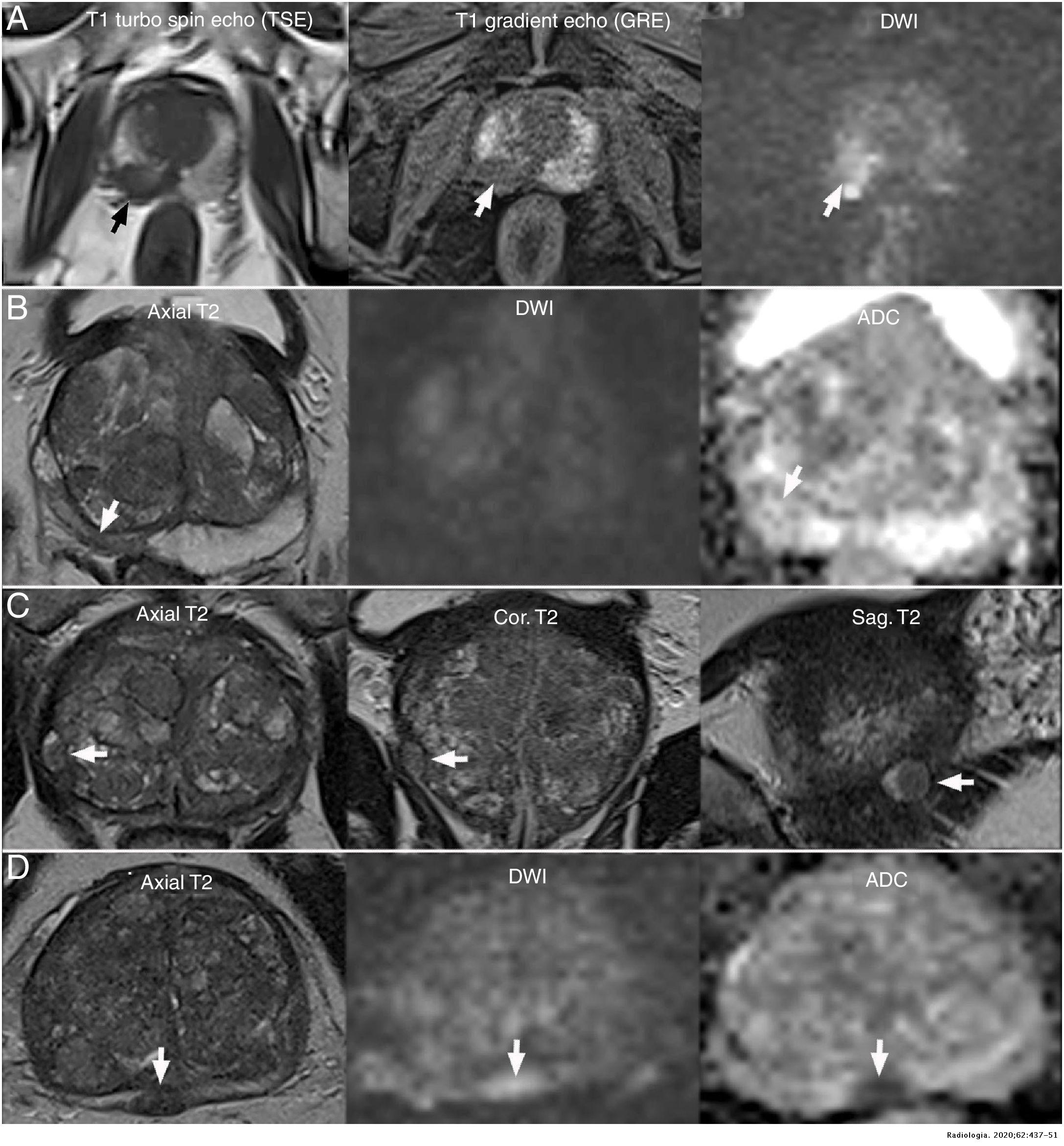 Prostate MRI: Practical guidelines for interpreting and reporting ...