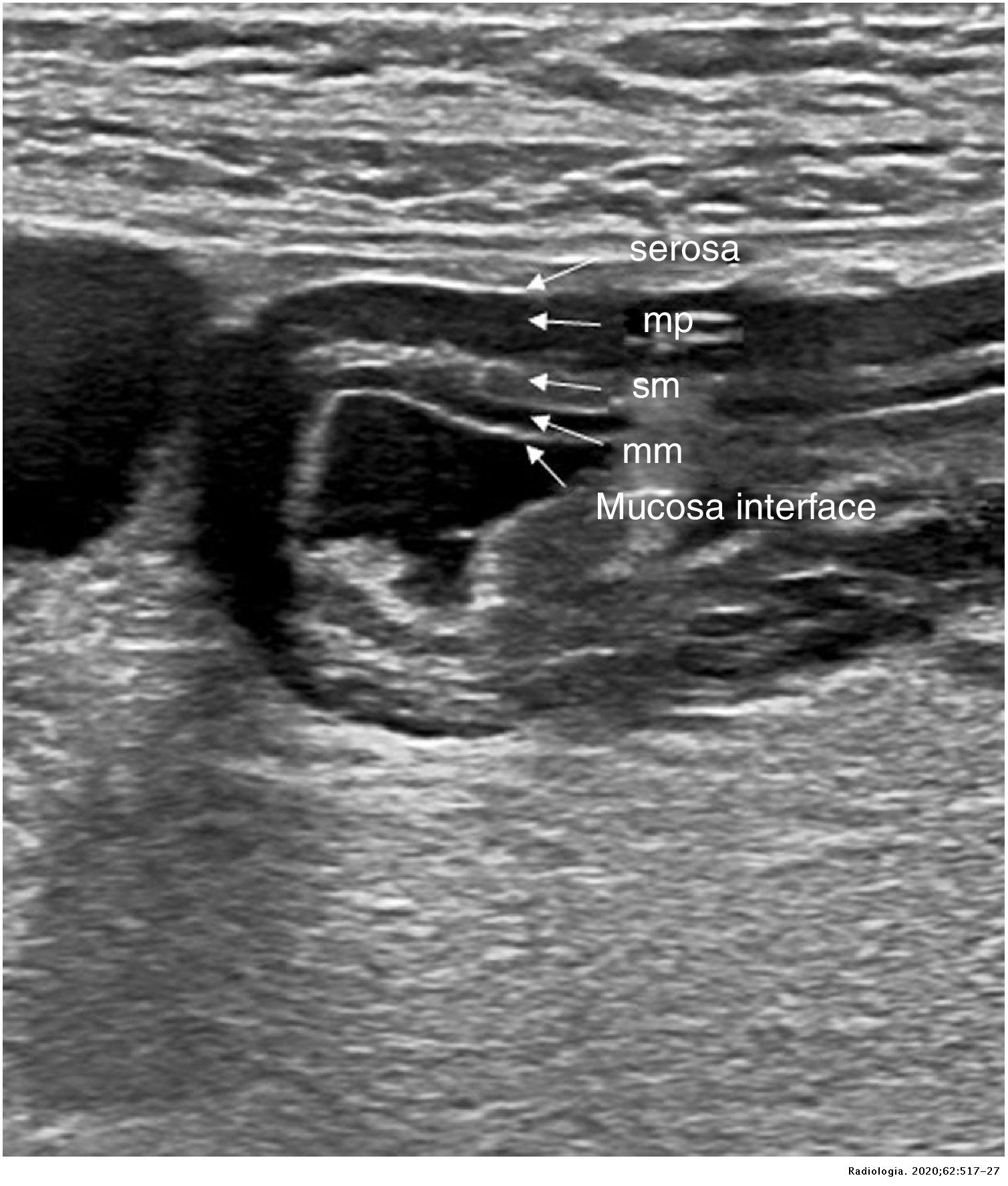 Bowel ultrasound: Examination techniques and normal and pathologic ...