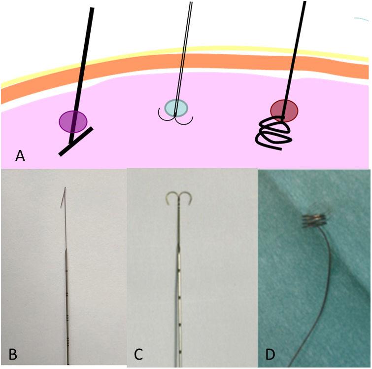 CT-guided hook-wire localization of pulmonary nodules in children prior ...