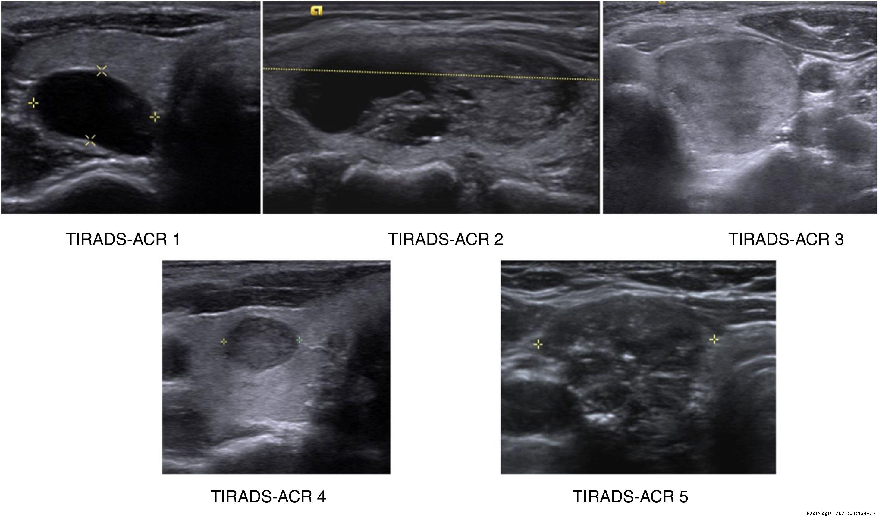 Concordance of the ACR TI-RADS | Radiología (English Edition)