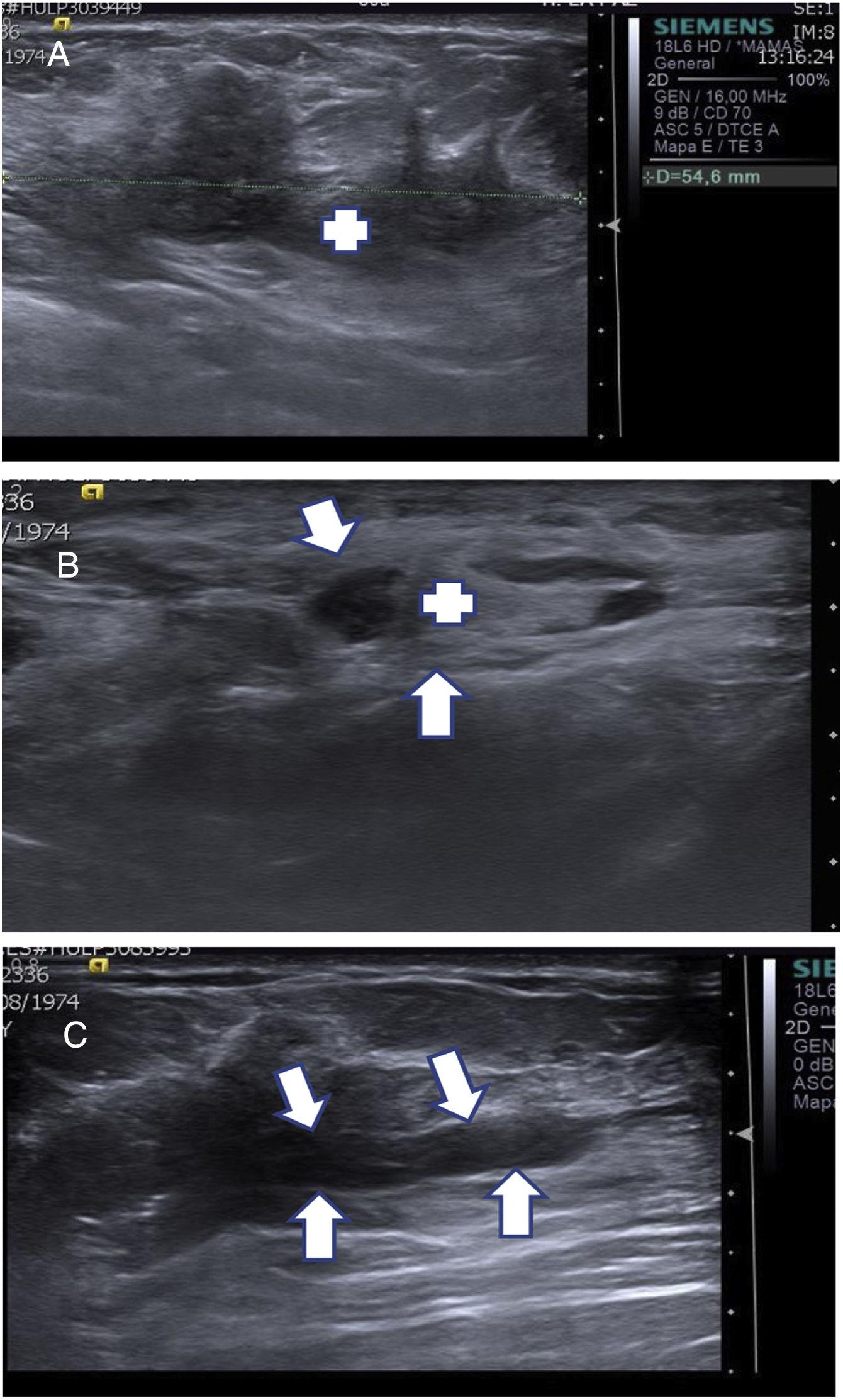 Ultrasound-guided interventional procedures in breast imaging ...