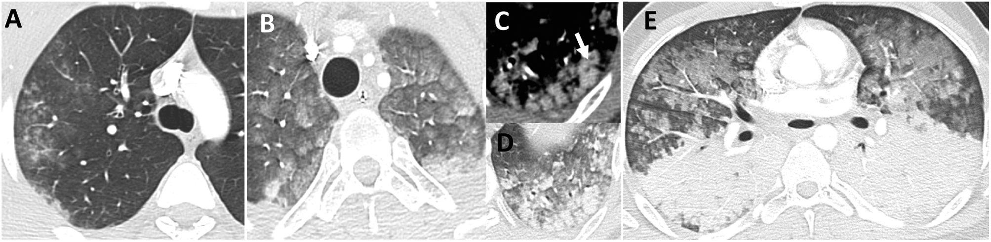 Severe non-cardiovascular thoracic trauma: diagnostic clues on computed ...
