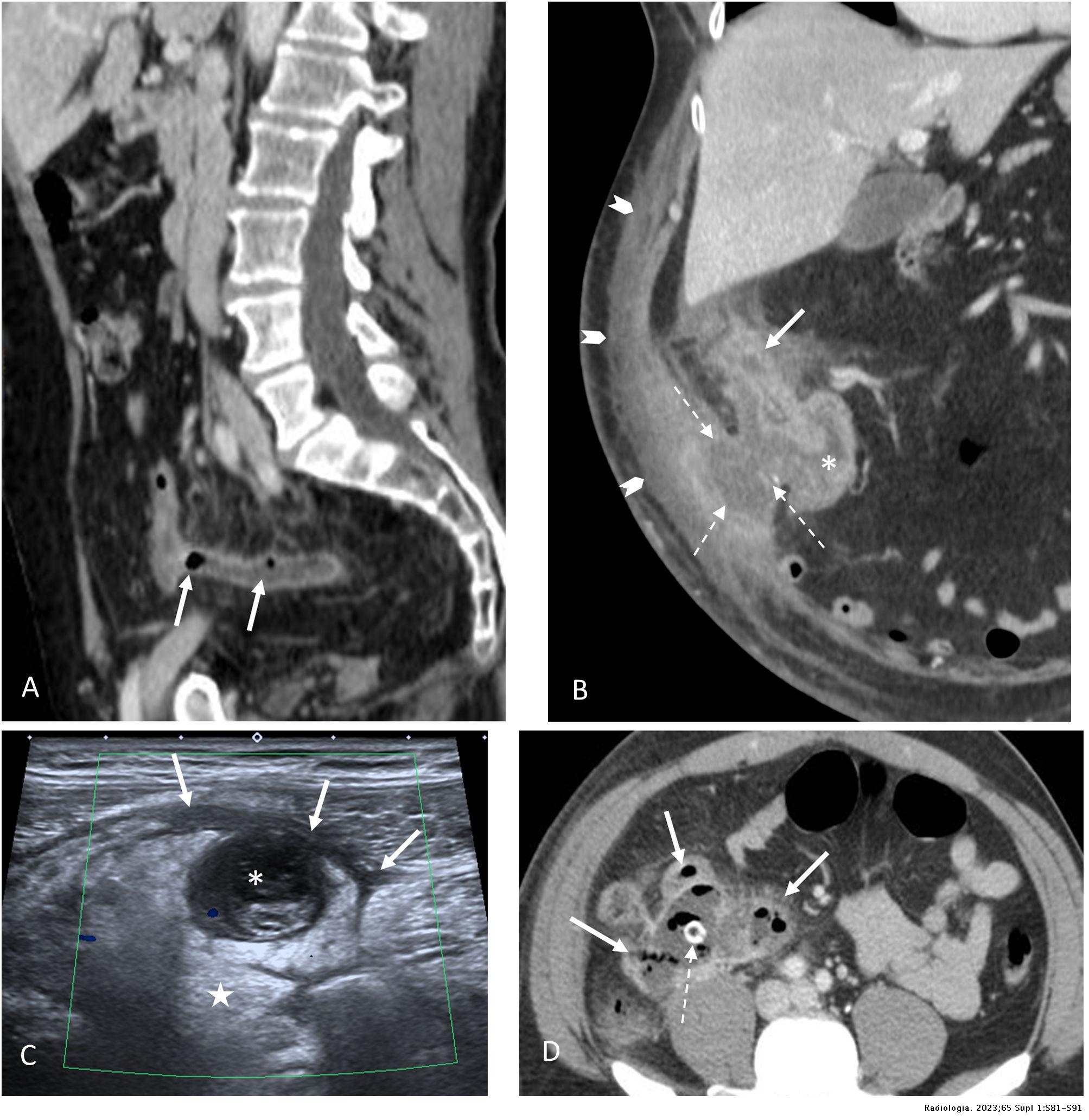 Update on acute appendicitis: Typical and untypical findings ...