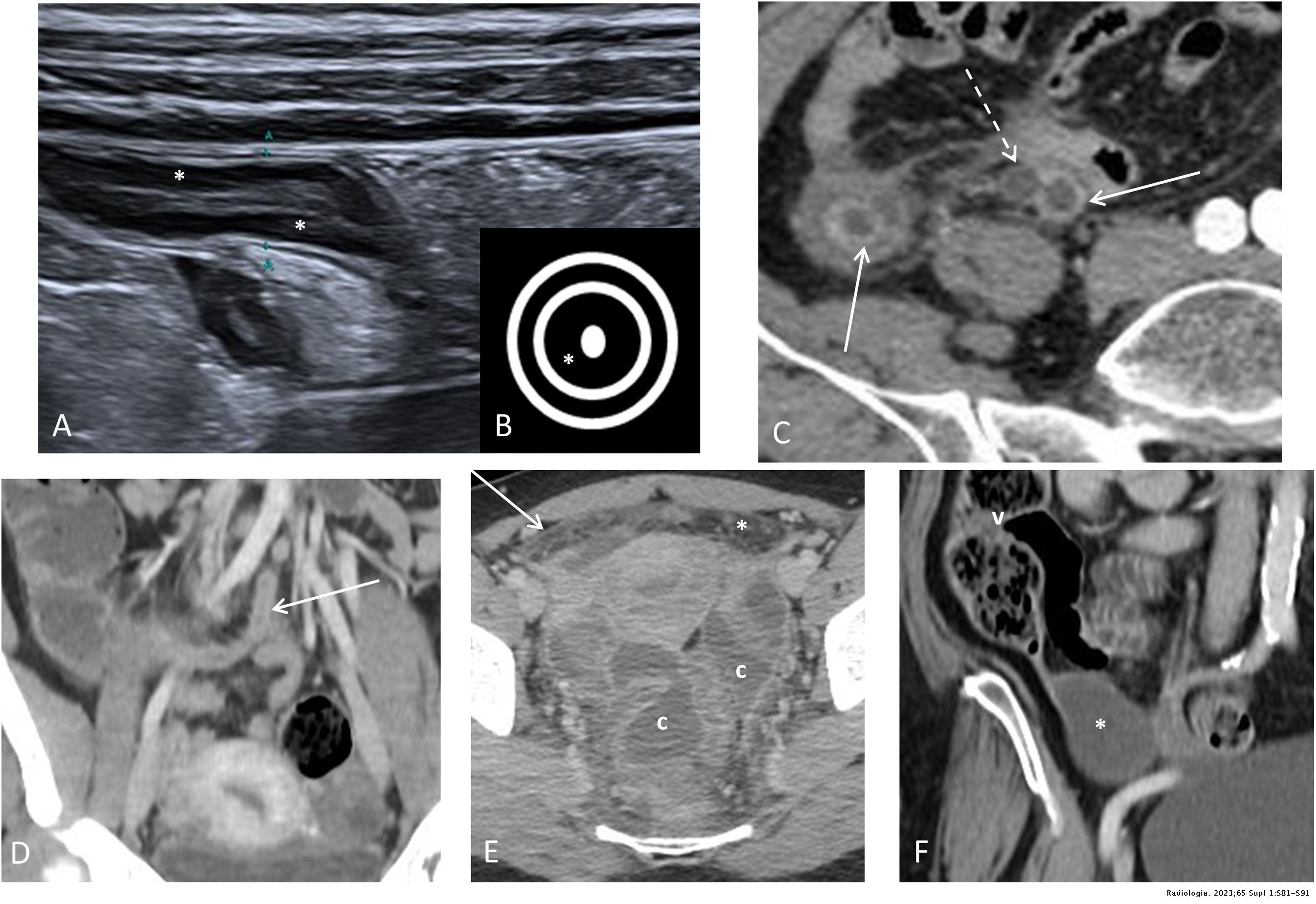 Update on acute appendicitis: Typical and untypical findings ...