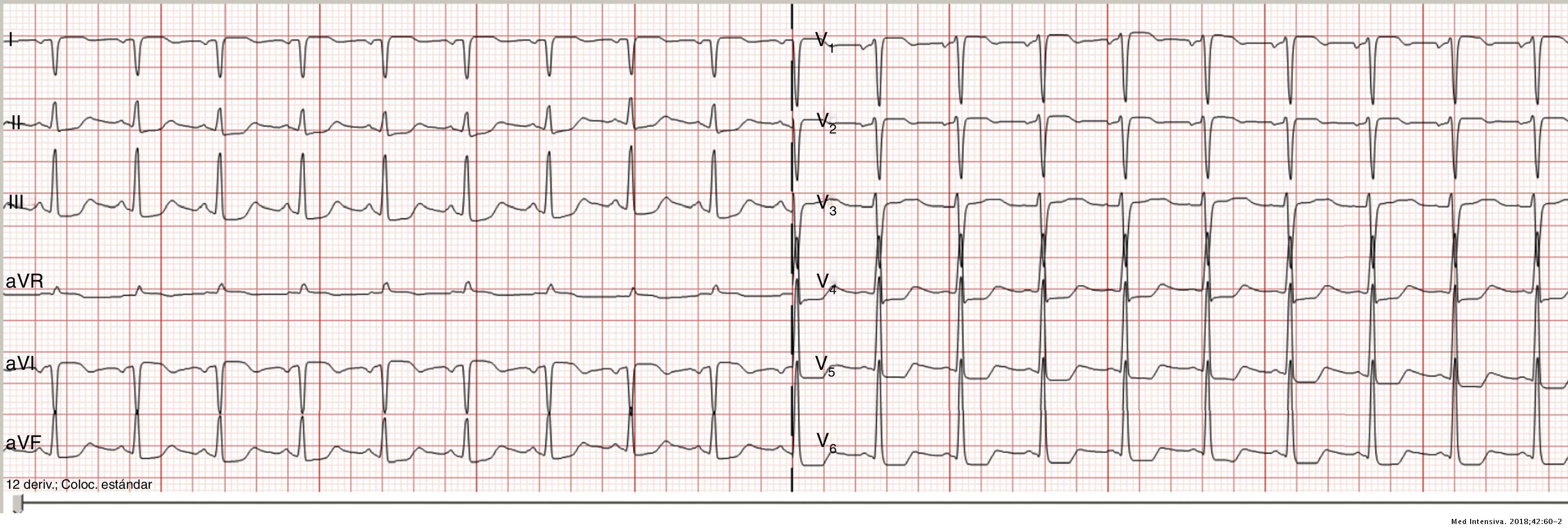 Treatment with carfilzomib. Should these patients be admitted to the ...