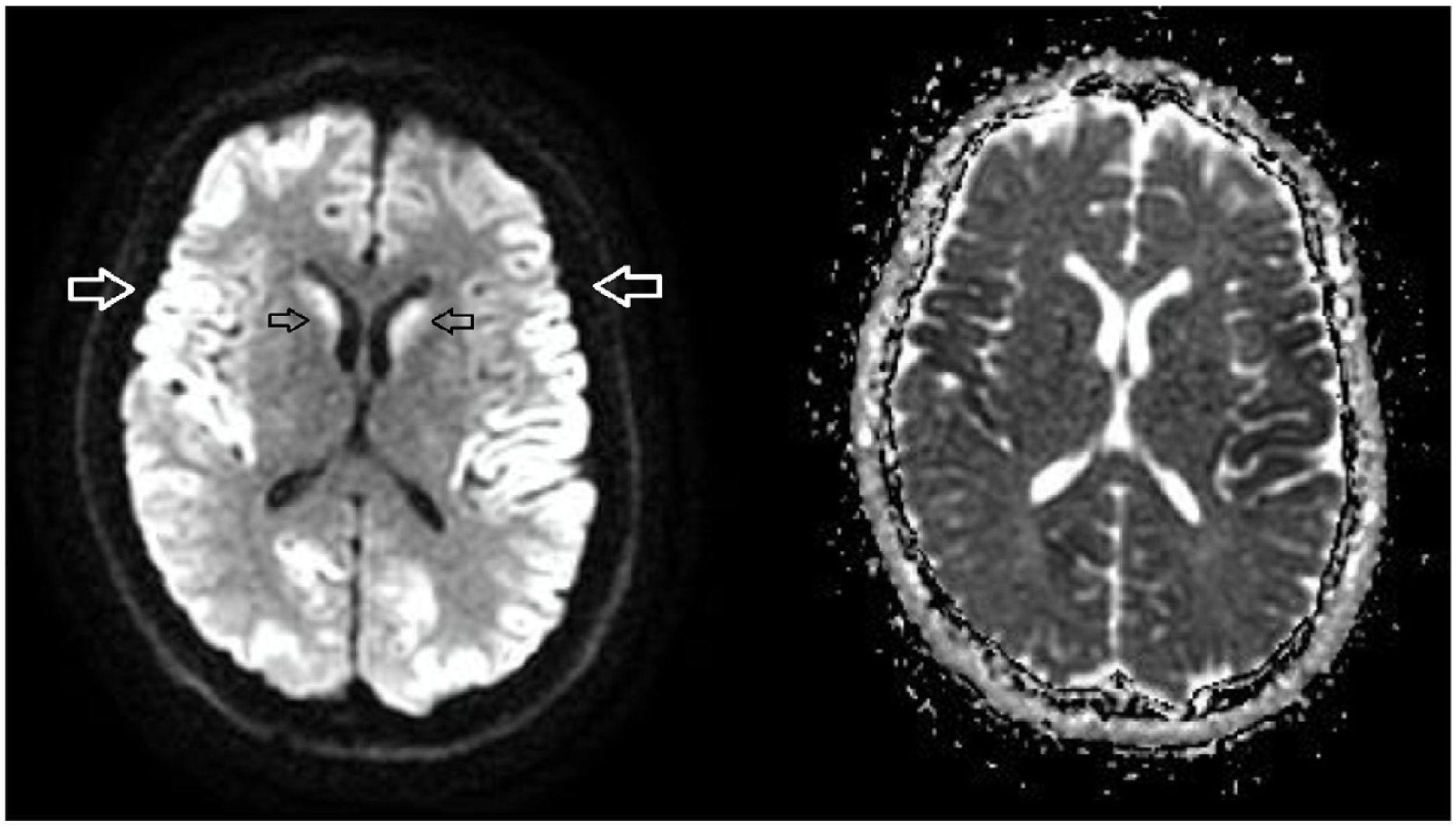 Hypoglycemic encephalopathy. The role of magnetic resonance imaging in ...