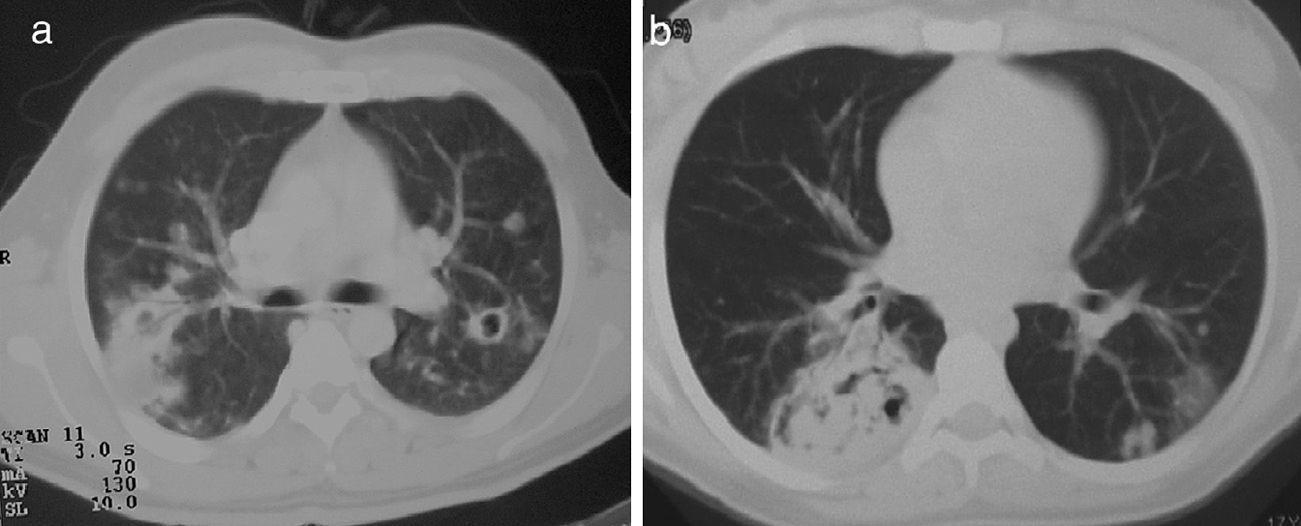 Pulmonary Manifestations of Granulomatosis With Polyangiitis ...