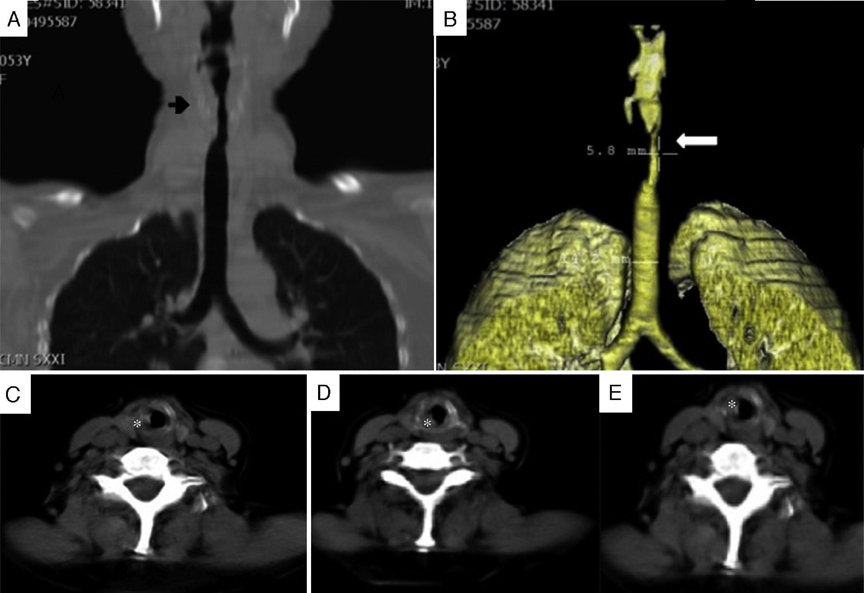 Subglottic Stenosis in Granulomatosis With Polyangiitis (Wegener's