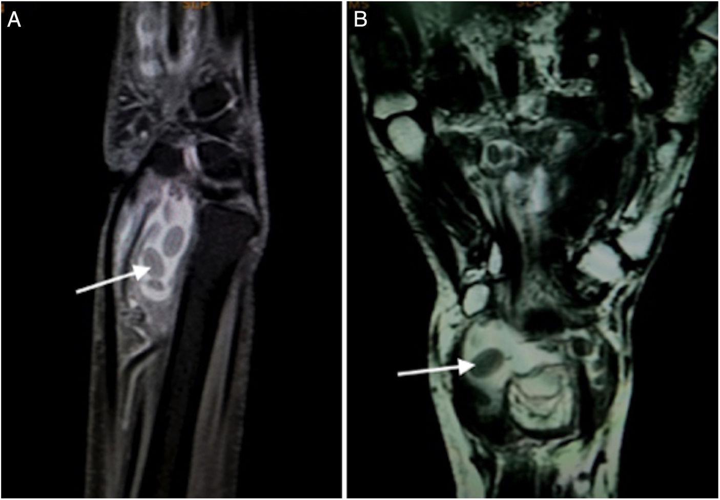 Rice Bodies in Tuberculous Tenosynovitis of Wrist Reumatología Clínica