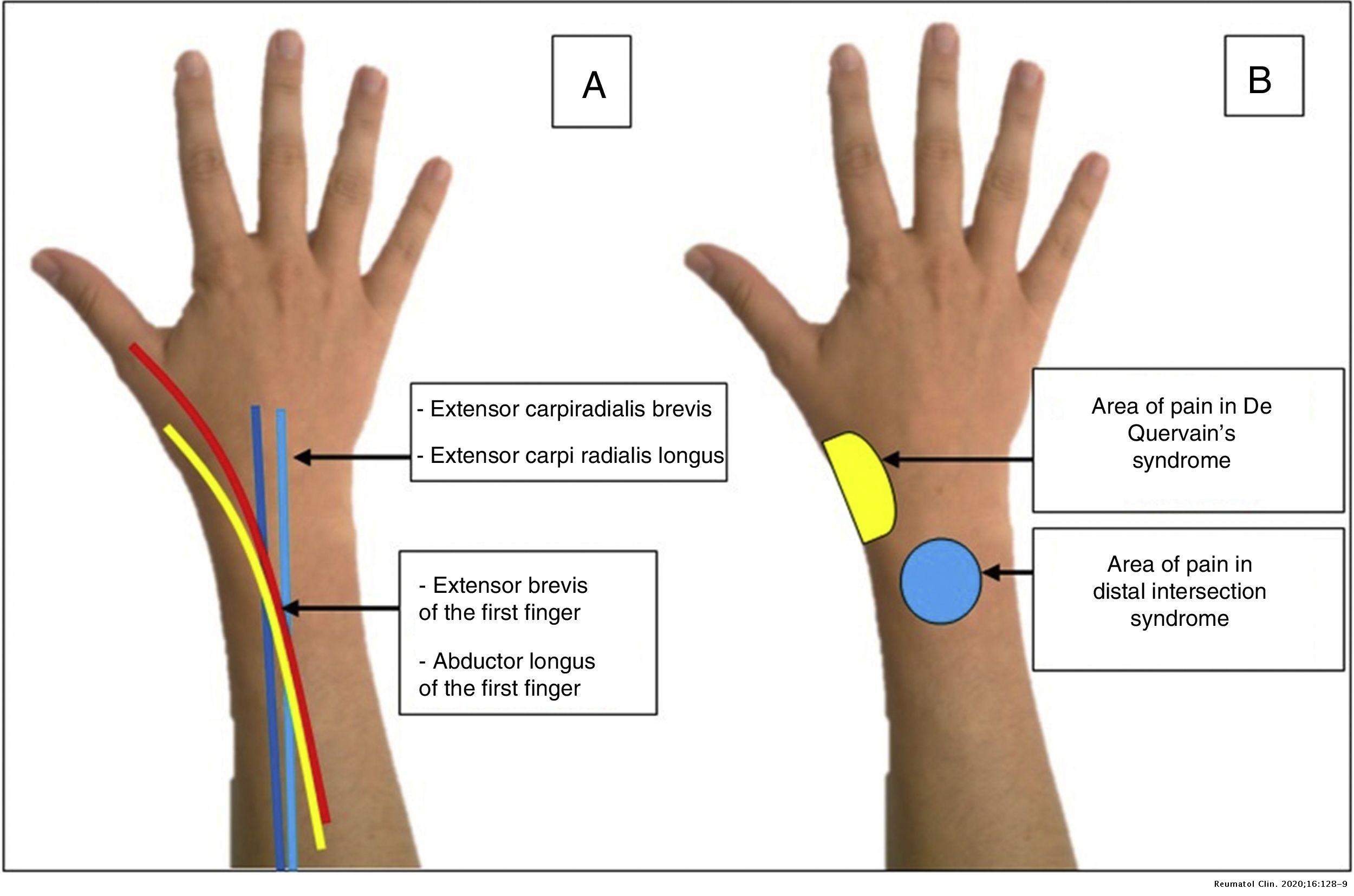 Extensor Tendonitis Wrist