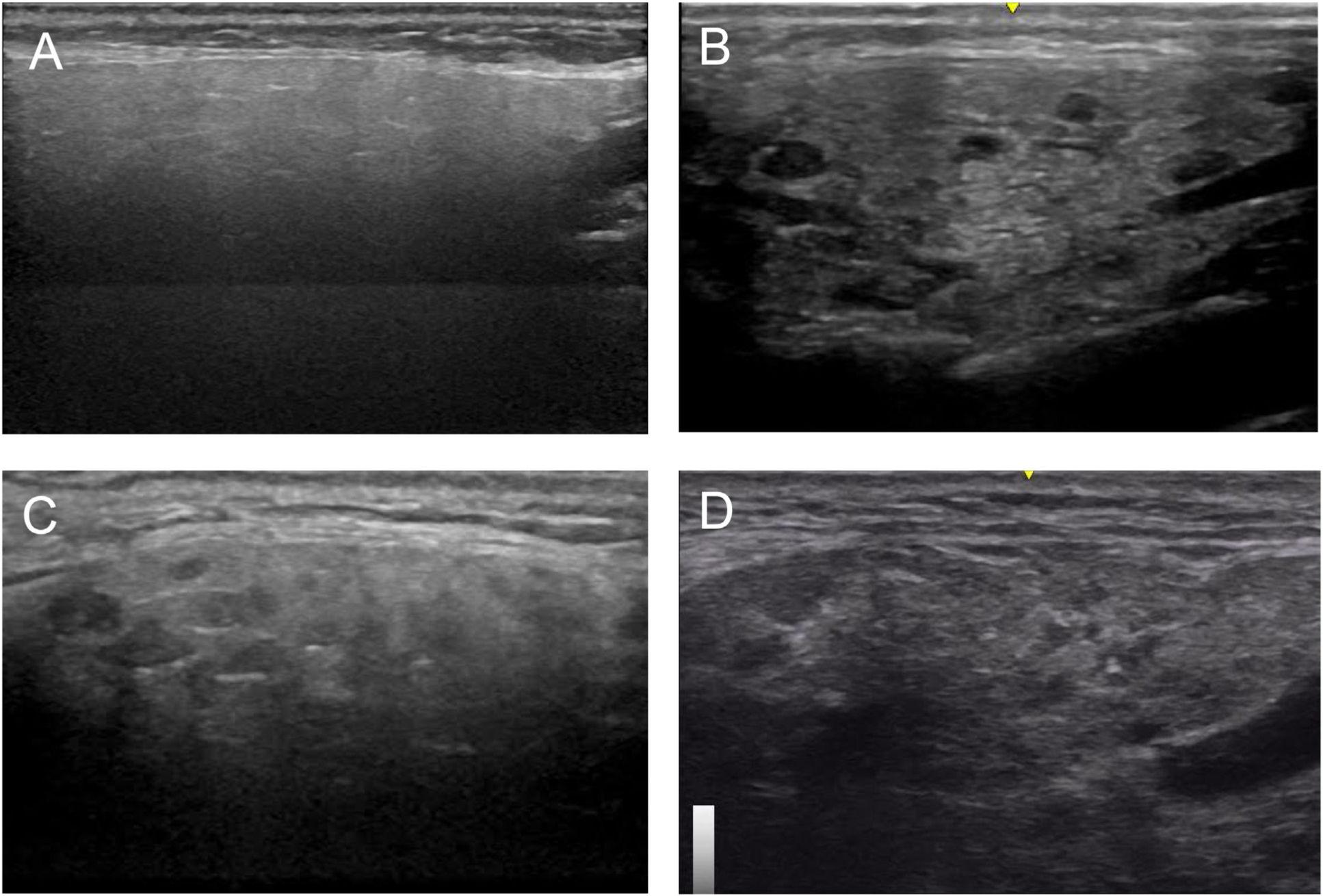 Salivary gland ultrasound in clinical practice: What is its real ...