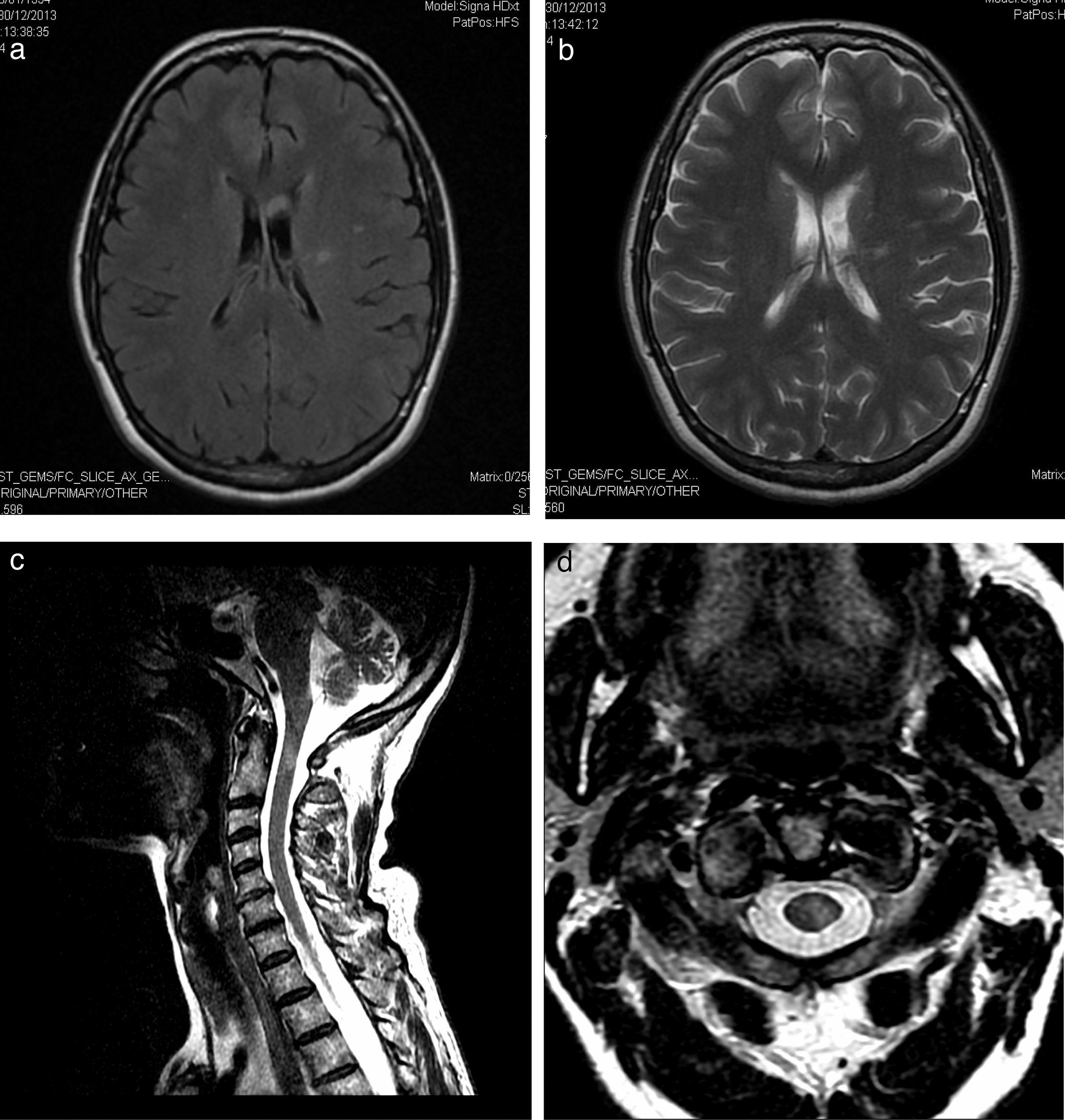 Confused About Brain Structure?  Corona Radiata Vs. Centrum Semiovale Explained