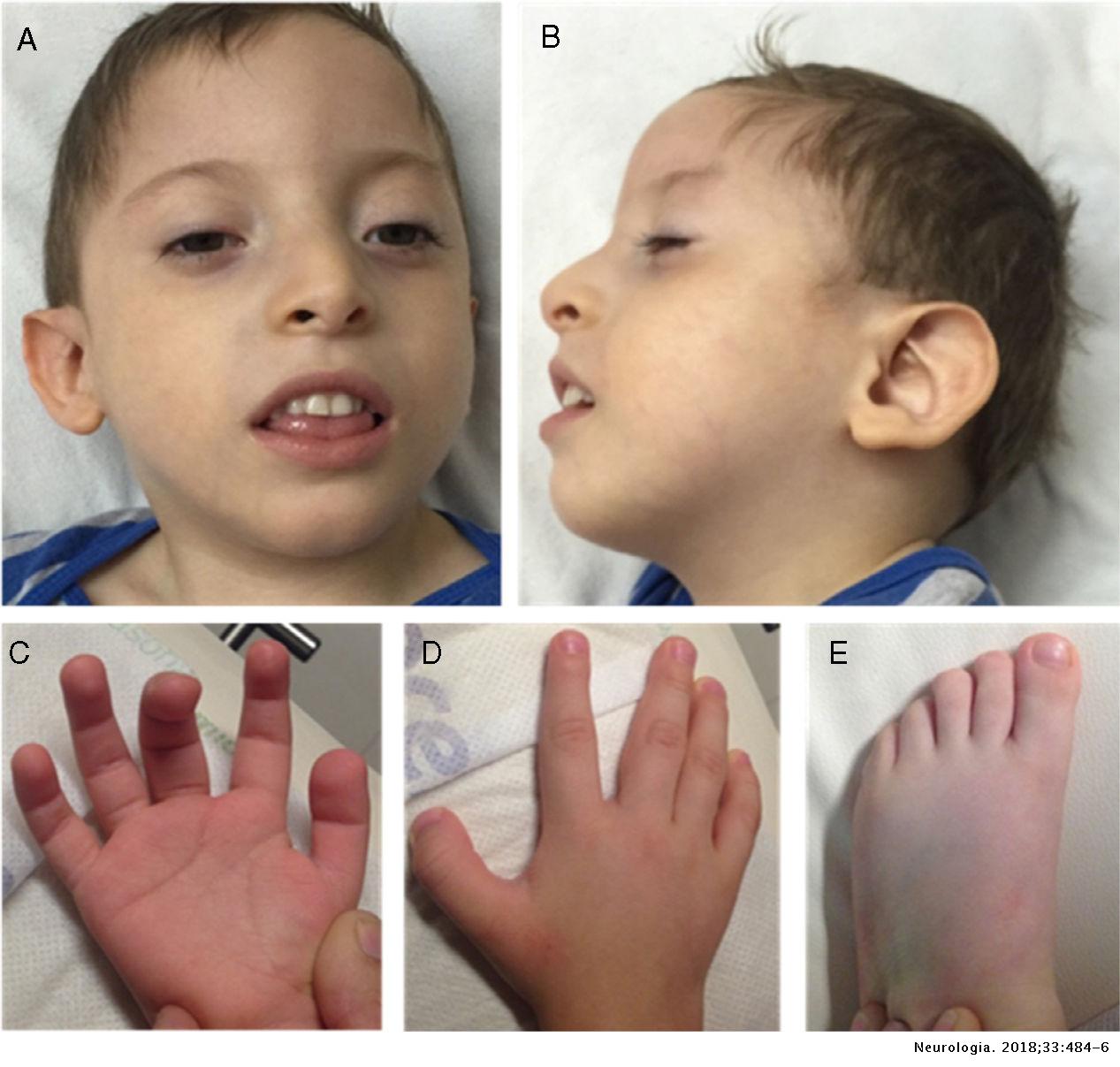 Global developmental delay and postnatal microcephaly: Bainbridge ...