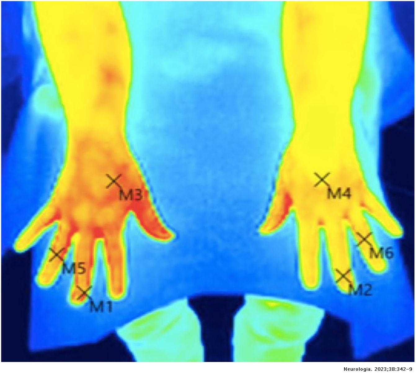 Usefulness of thermography in the diagnosis and classification of ...