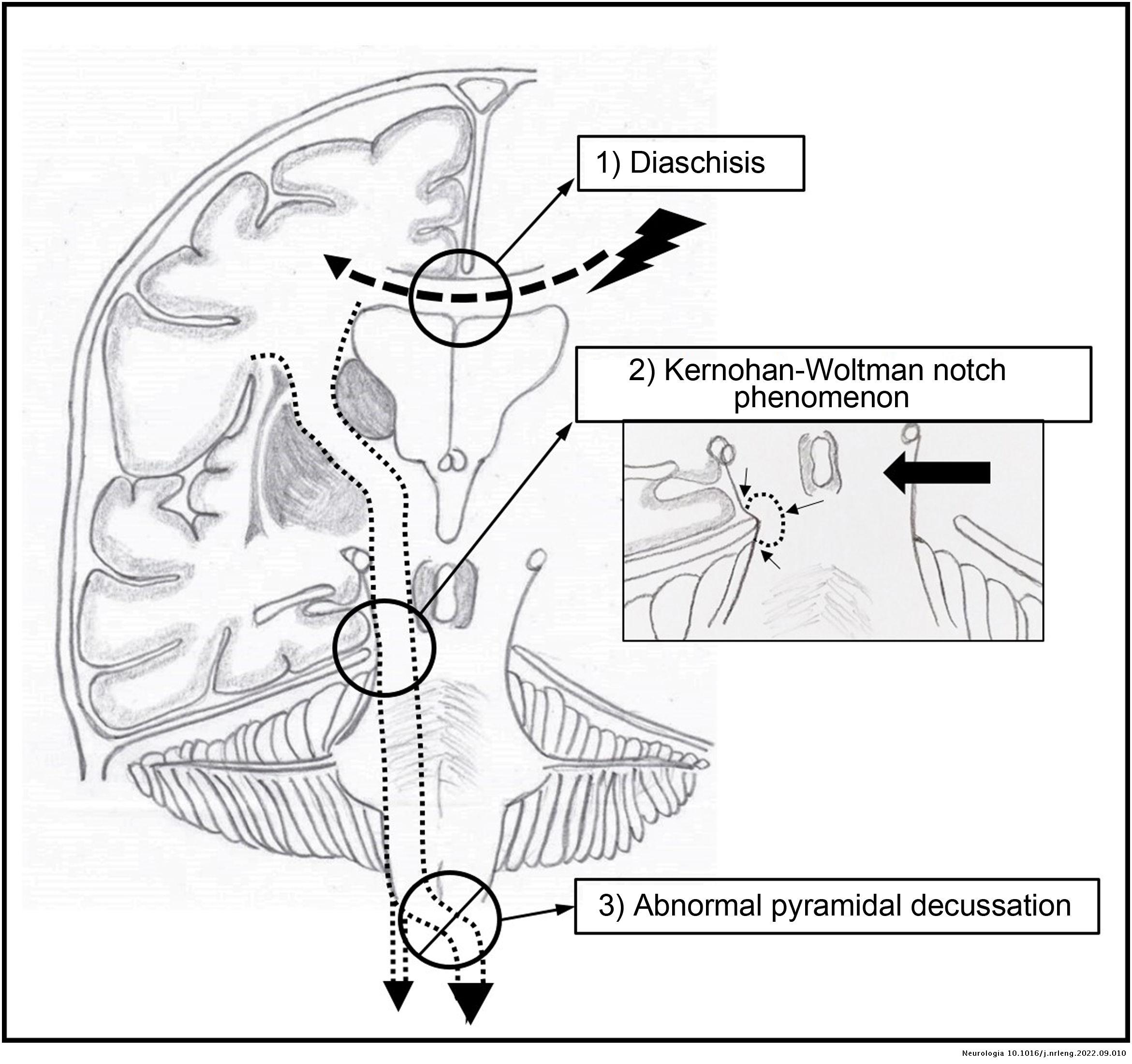 Kernohan-Woltman notch phenomenon: an exceptional neurological picture ...