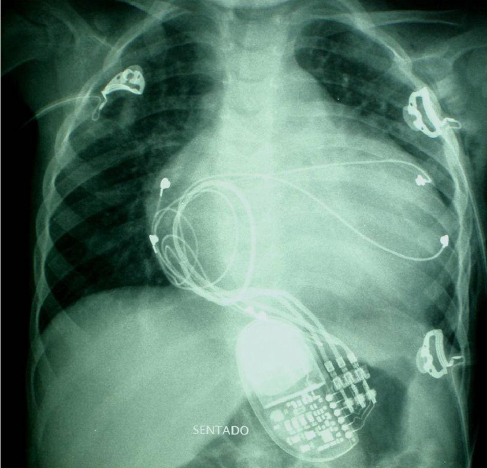 Biventricular Pacemaker Chest X Ray
