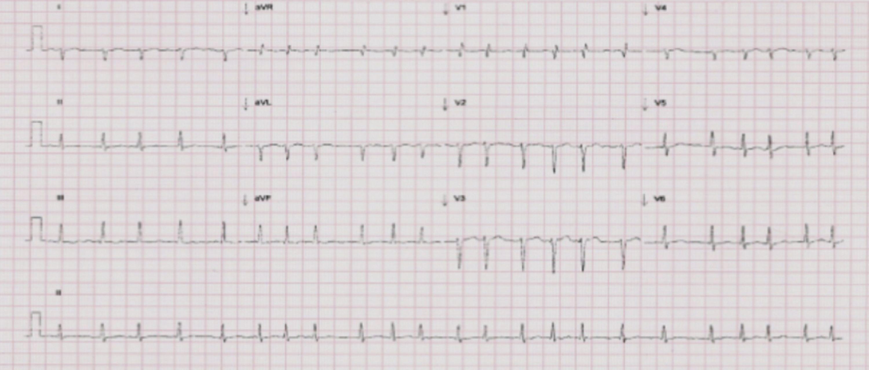 Pulmonary hypertension, heart failure and hyperthyroidism: A case ...