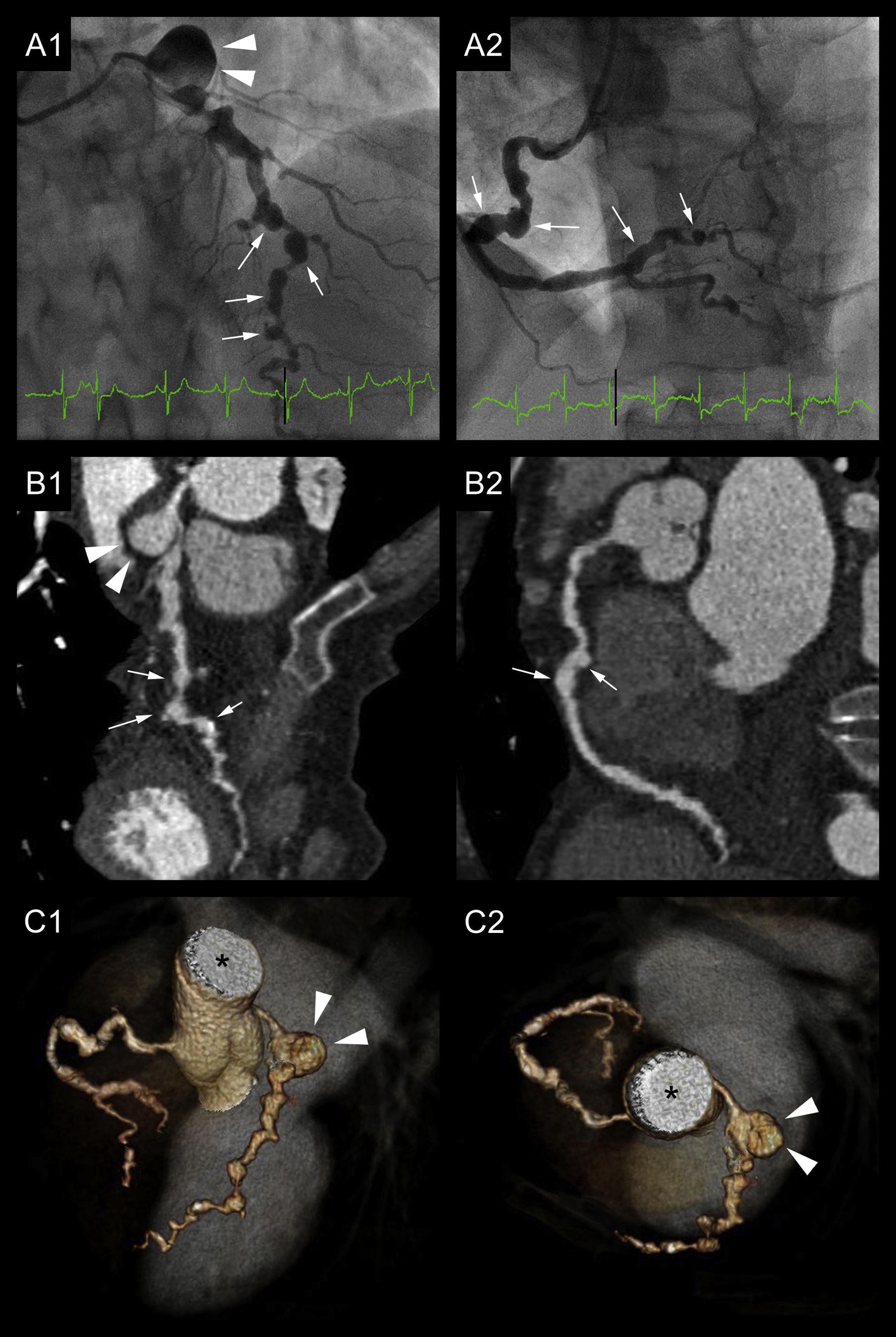 Diffuse aneurysmal and obstructive coronary artery disease A donot