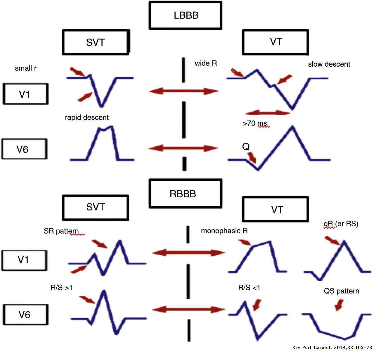 The value of electrocardiography for differential diagnosis in wide QRS ...