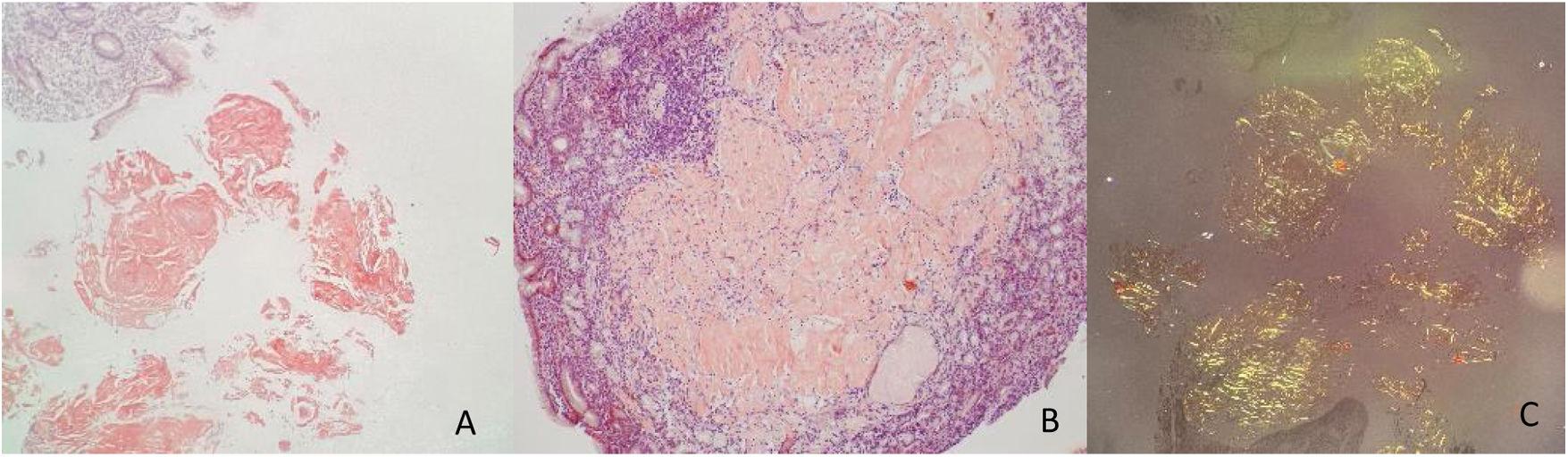 Gastrointestinal bleeding as the first manifestation of gastric