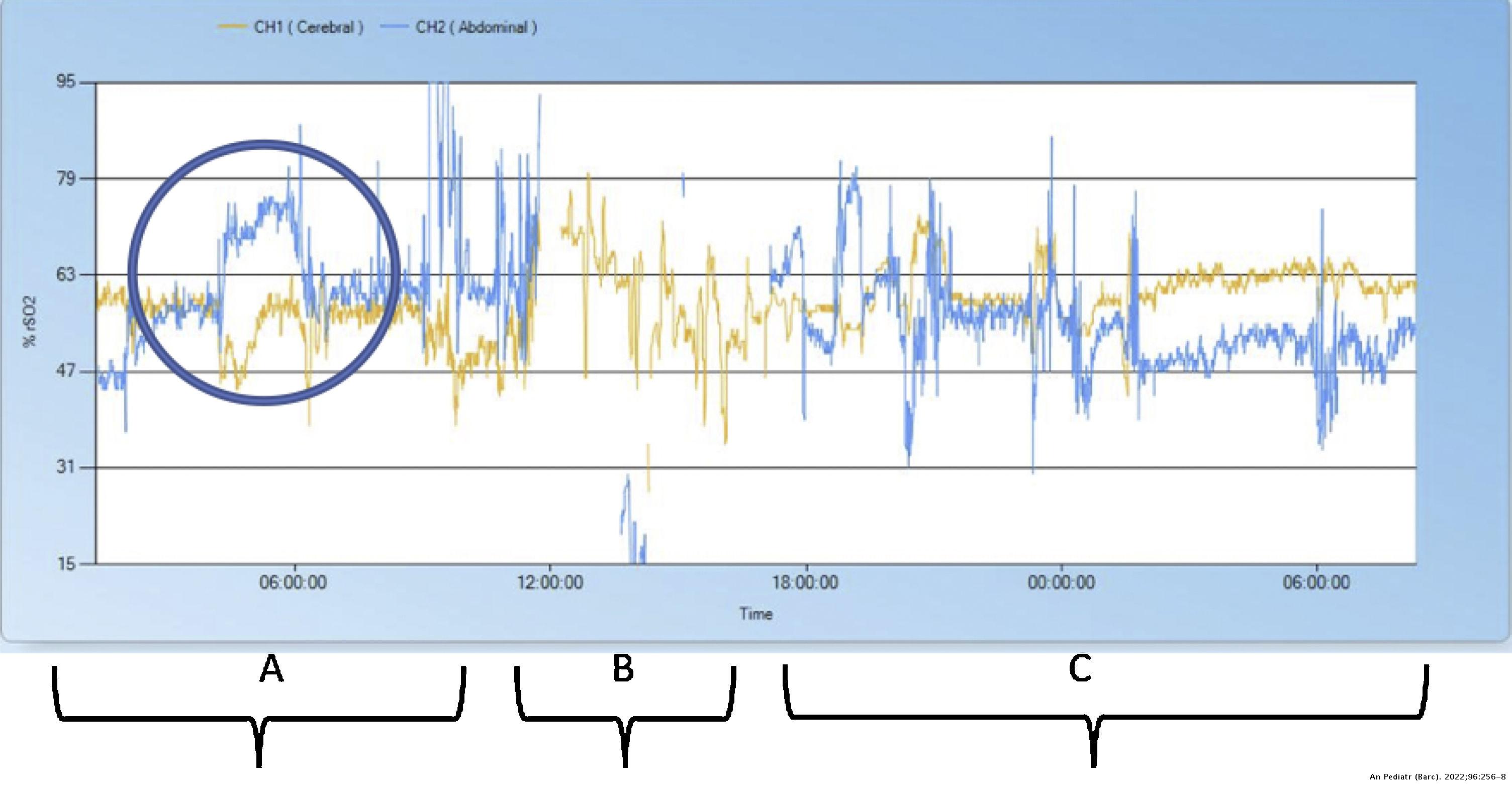 Use of near infrared spectroscopy in neonatal gastric perforation ...