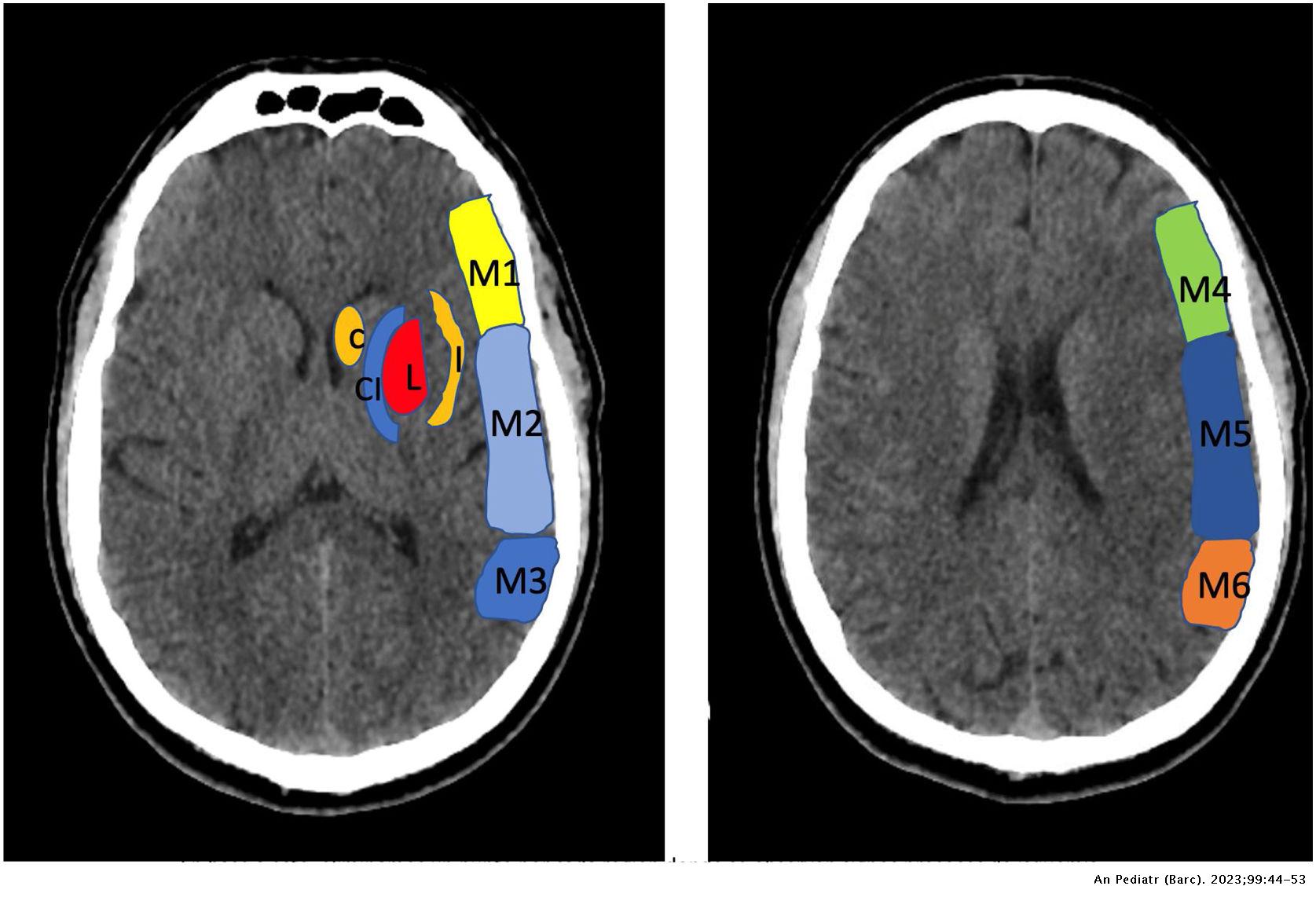 Acute recanalization treatments in postnatal paediatric ischaemic ...