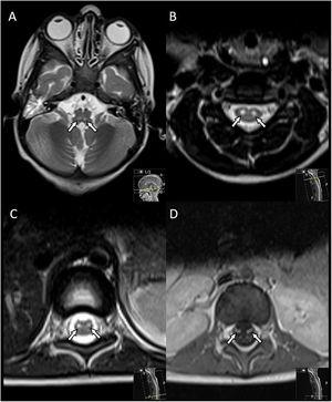 Neuroimaging of poliomyelitis-like syndrome by Epstein–Barr virus ...