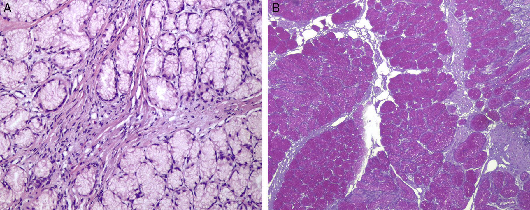 Brunner?s Brunner Glands Of The Duodenum With Their