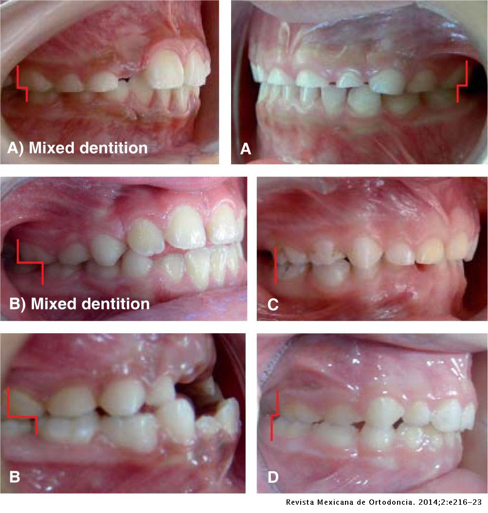 Prevalence of malocclusions associated with pernicious oral habits in a ...