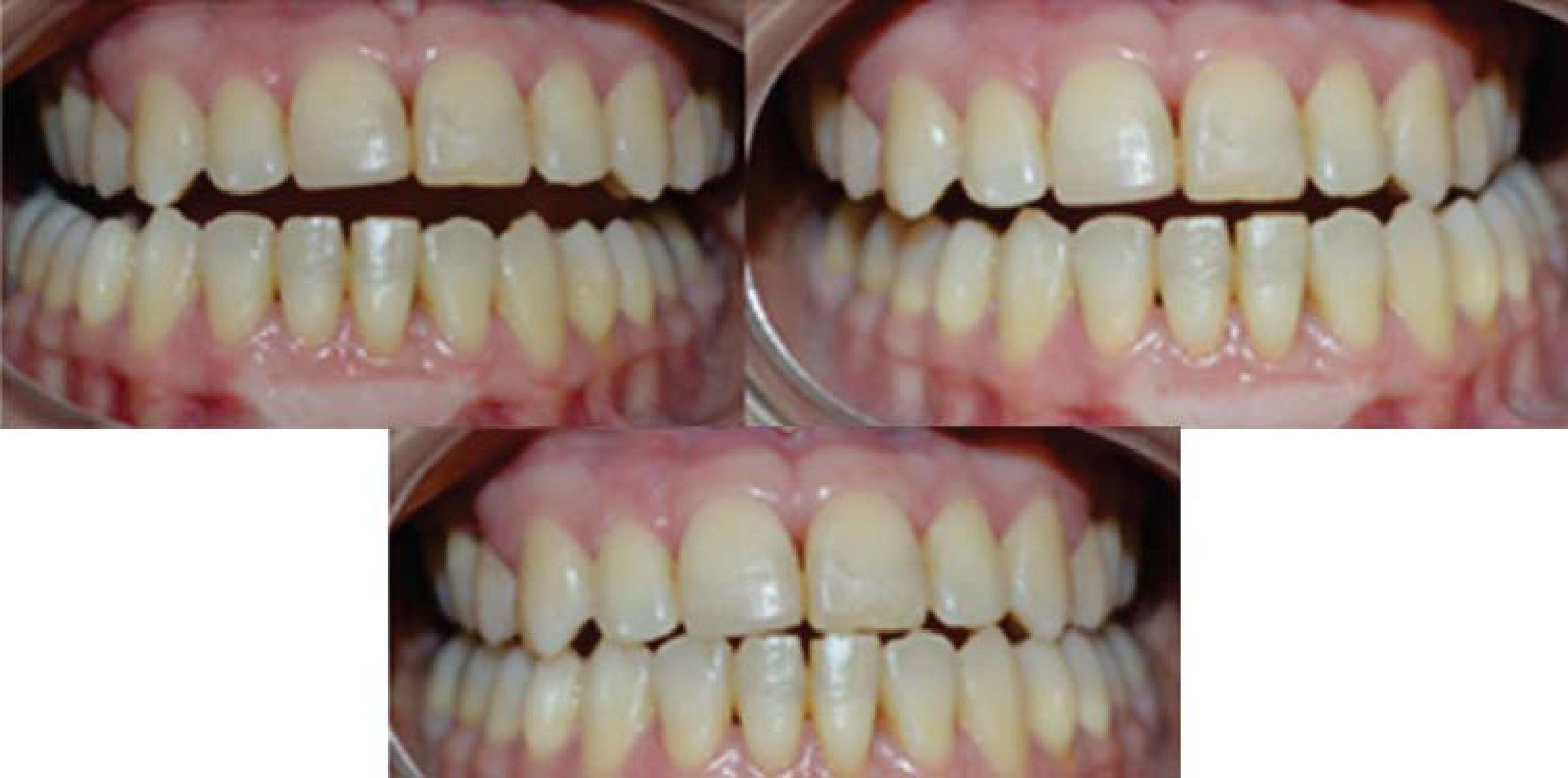 Orthodontic treatment in a periodontally compromised class III patient