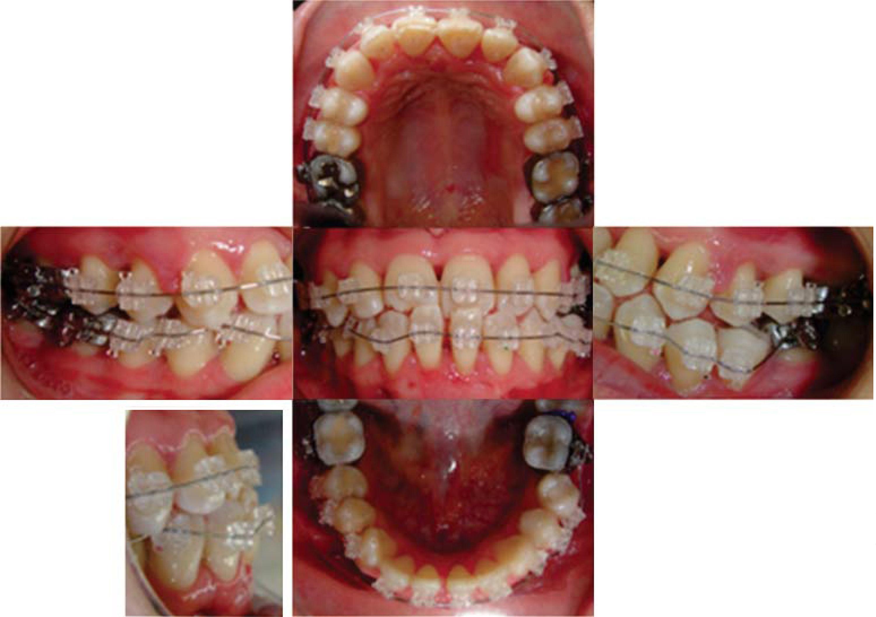 Orthodontic treatment in a periodontally compromised class III patient