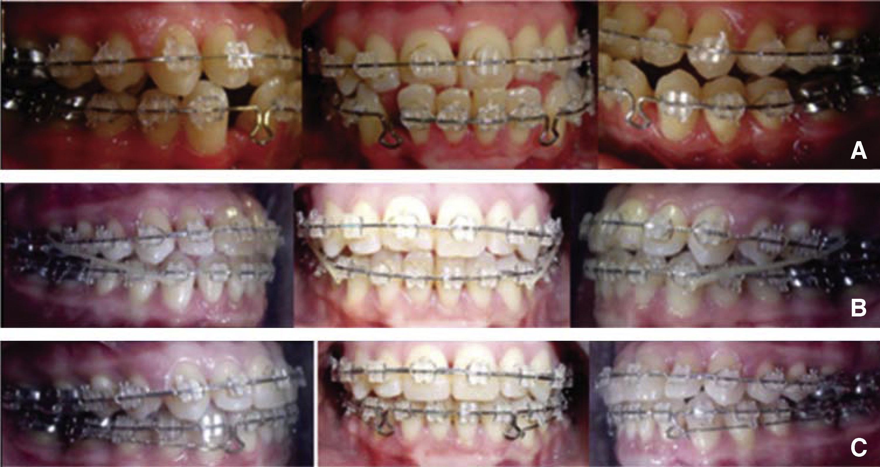 Orthodontic treatment in a periodontally compromised class III patient